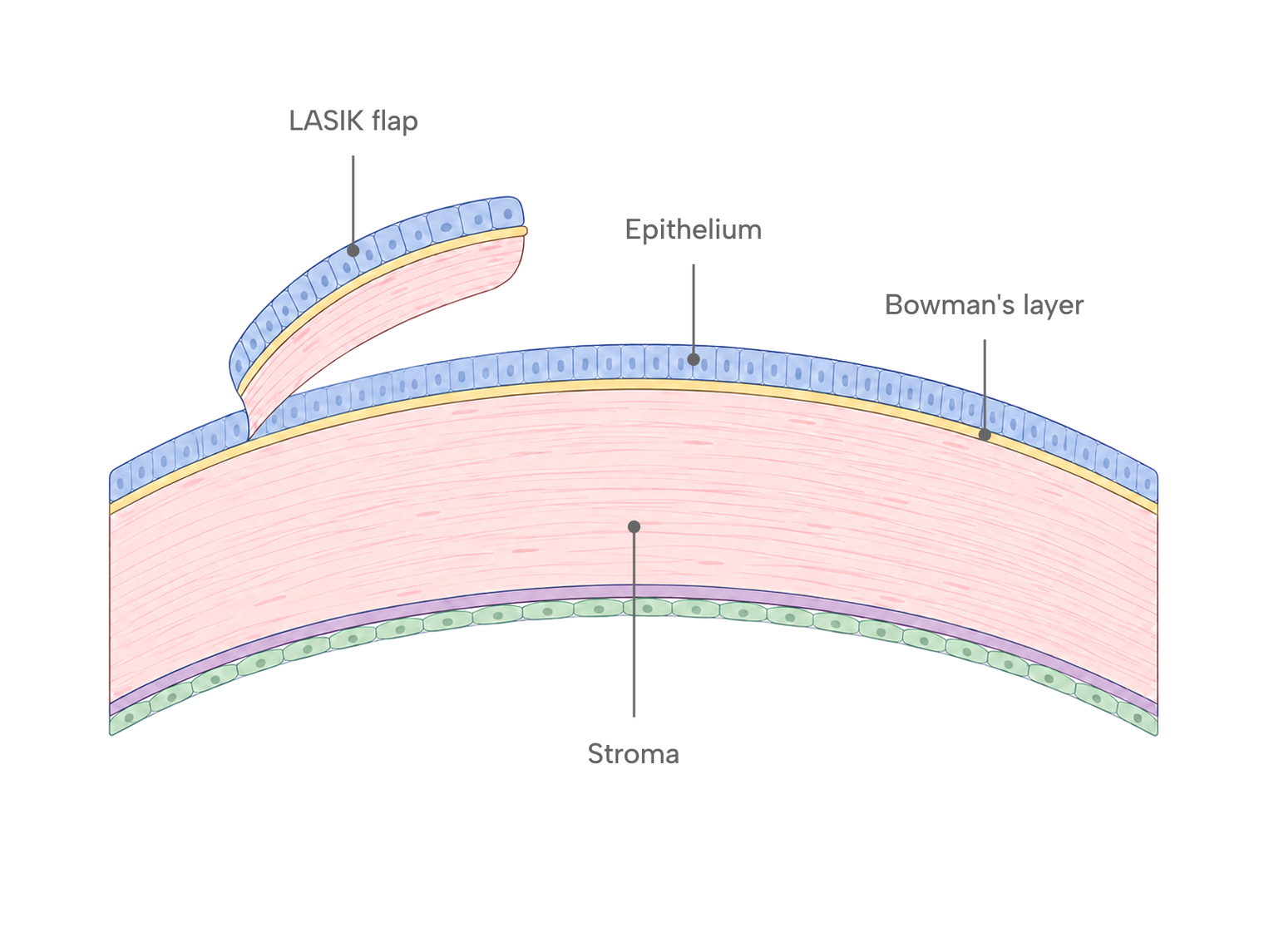 Cross-section diagram of the cornea showing the epithelium, Bowman's layer, and stroma, with the LASIK flap lifted from the outer layers.