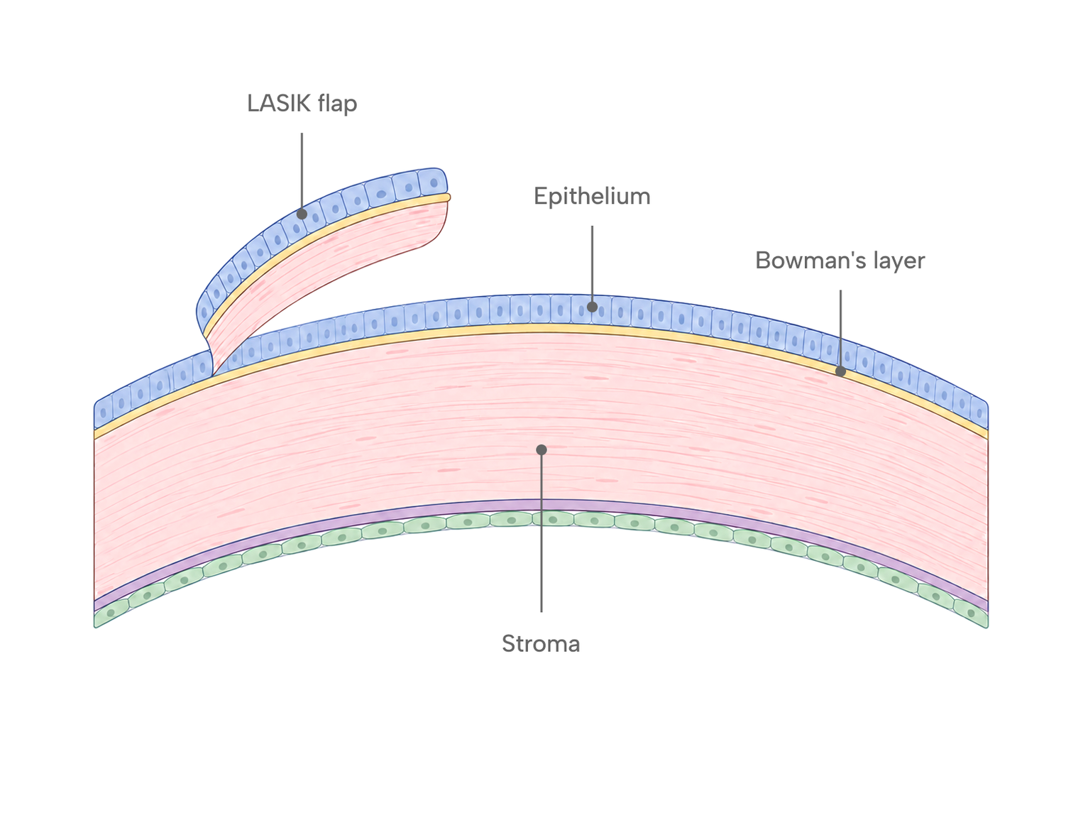 Cross-section diagram of the cornea showing the epithelium, Bowman's layer, and stroma, with the LASIK flap lifted from the outer layers.
