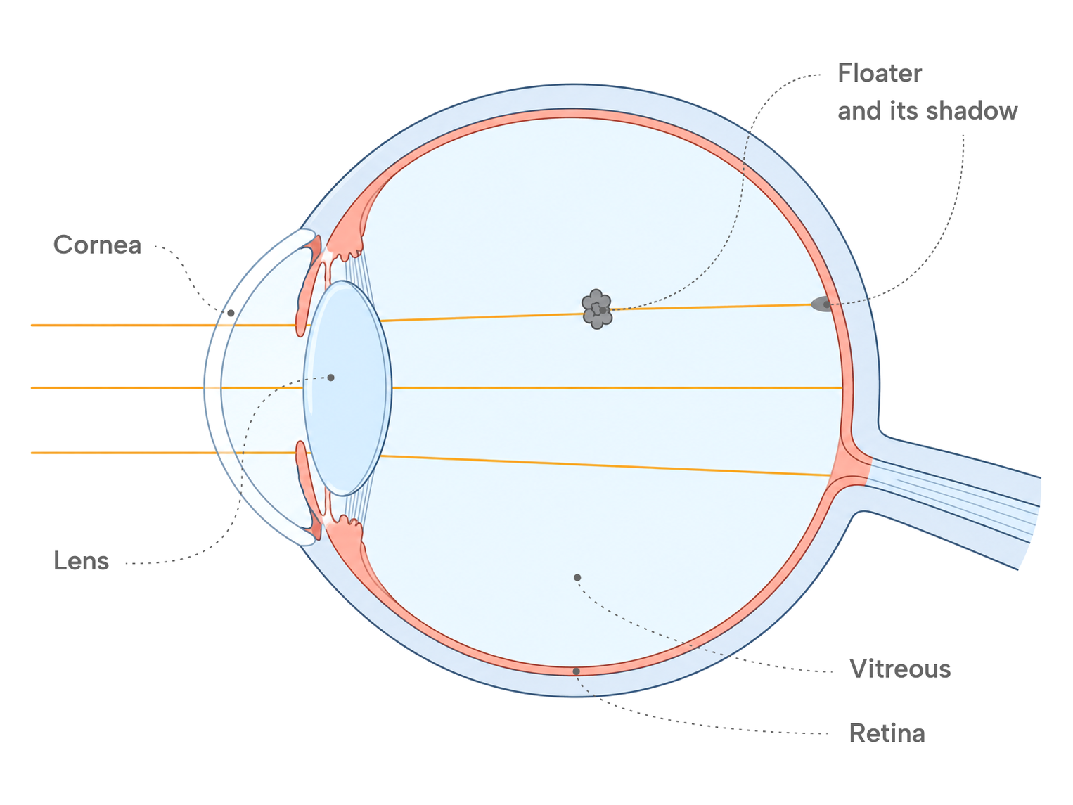 Cross-section diagram of the eye showing a floater in the vitreous casting a shadow on the retina