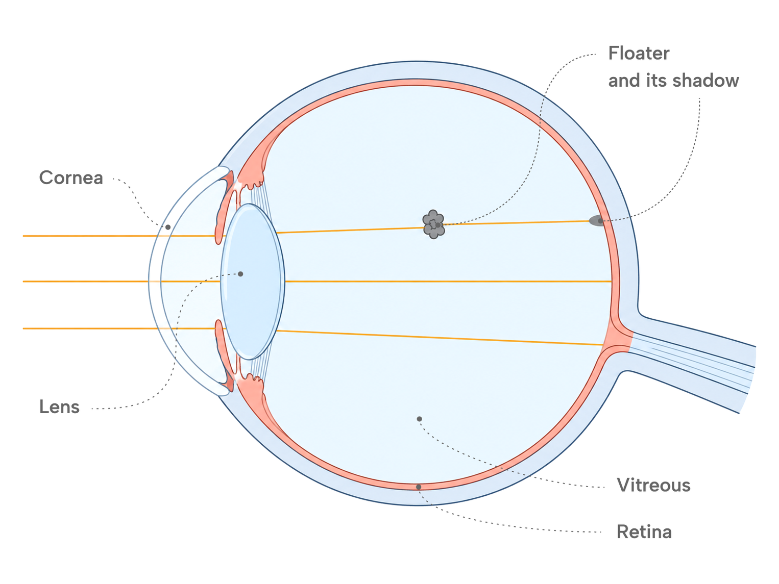 Cross-section diagram of the eye showing a floater in the vitreous casting a shadow on the retina