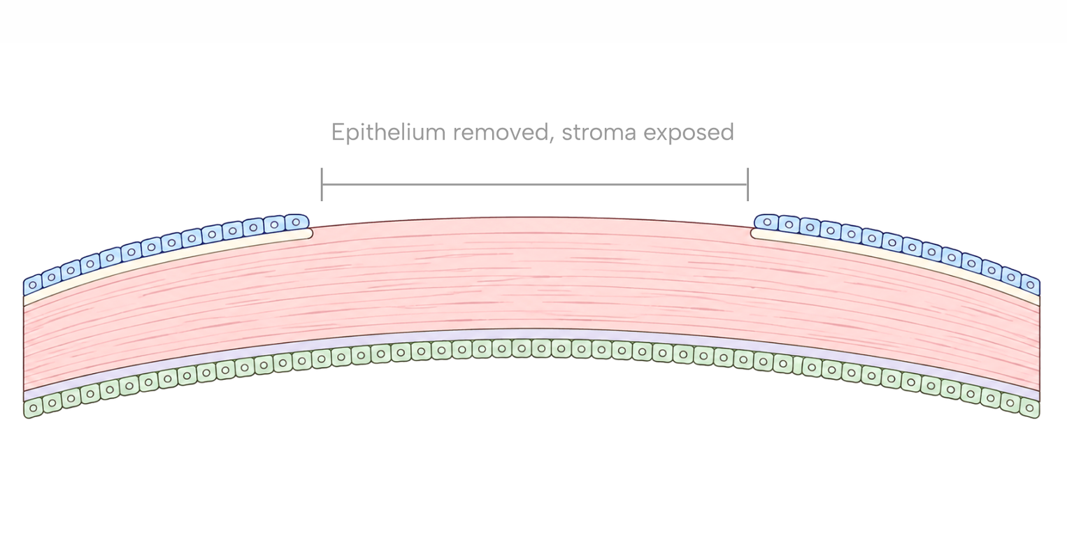 Side-by-side cross-section diagram showing LASIK working beneath a corneal flap and PRK working on the surface after the epithelium has been removed.