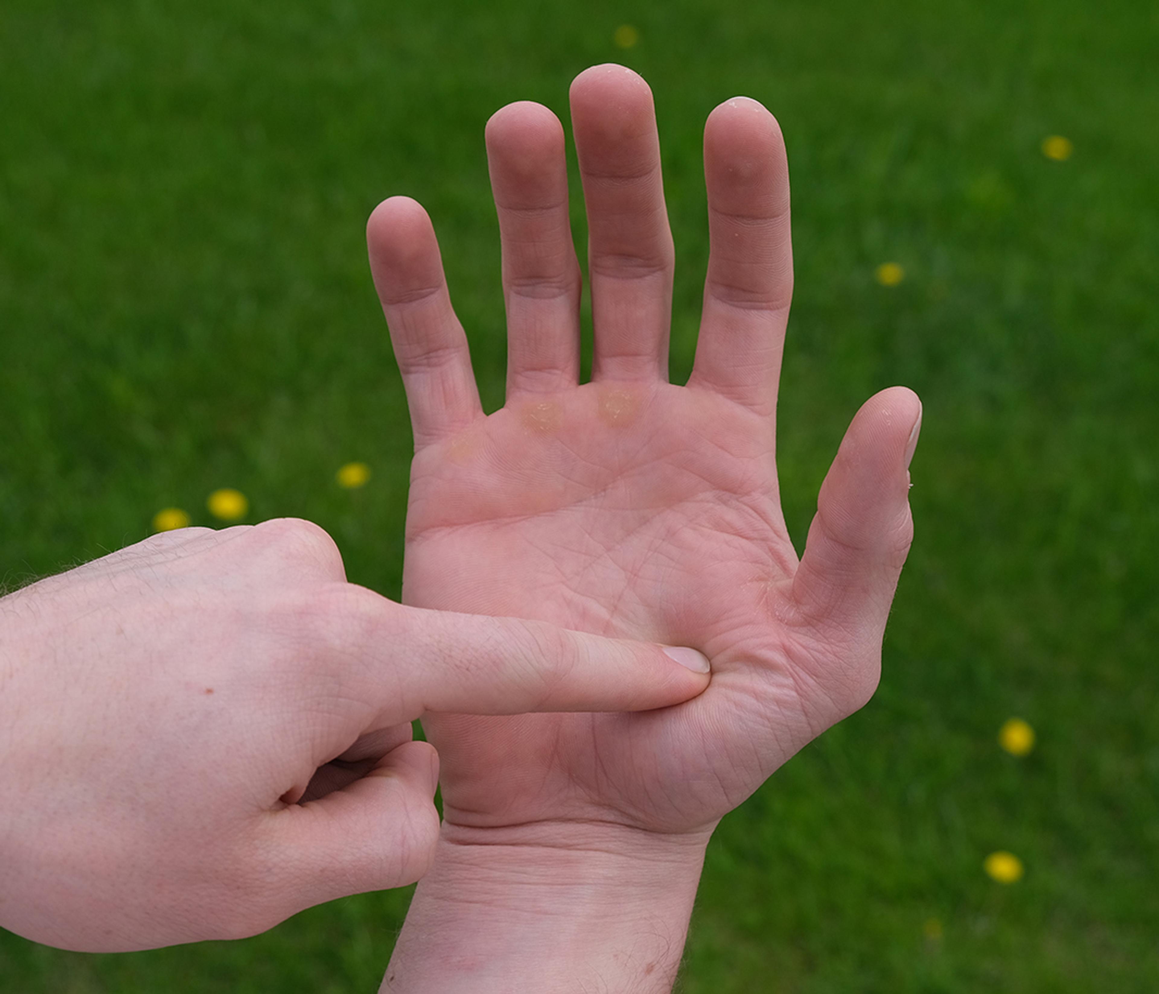 A man points to a spot on his hand.