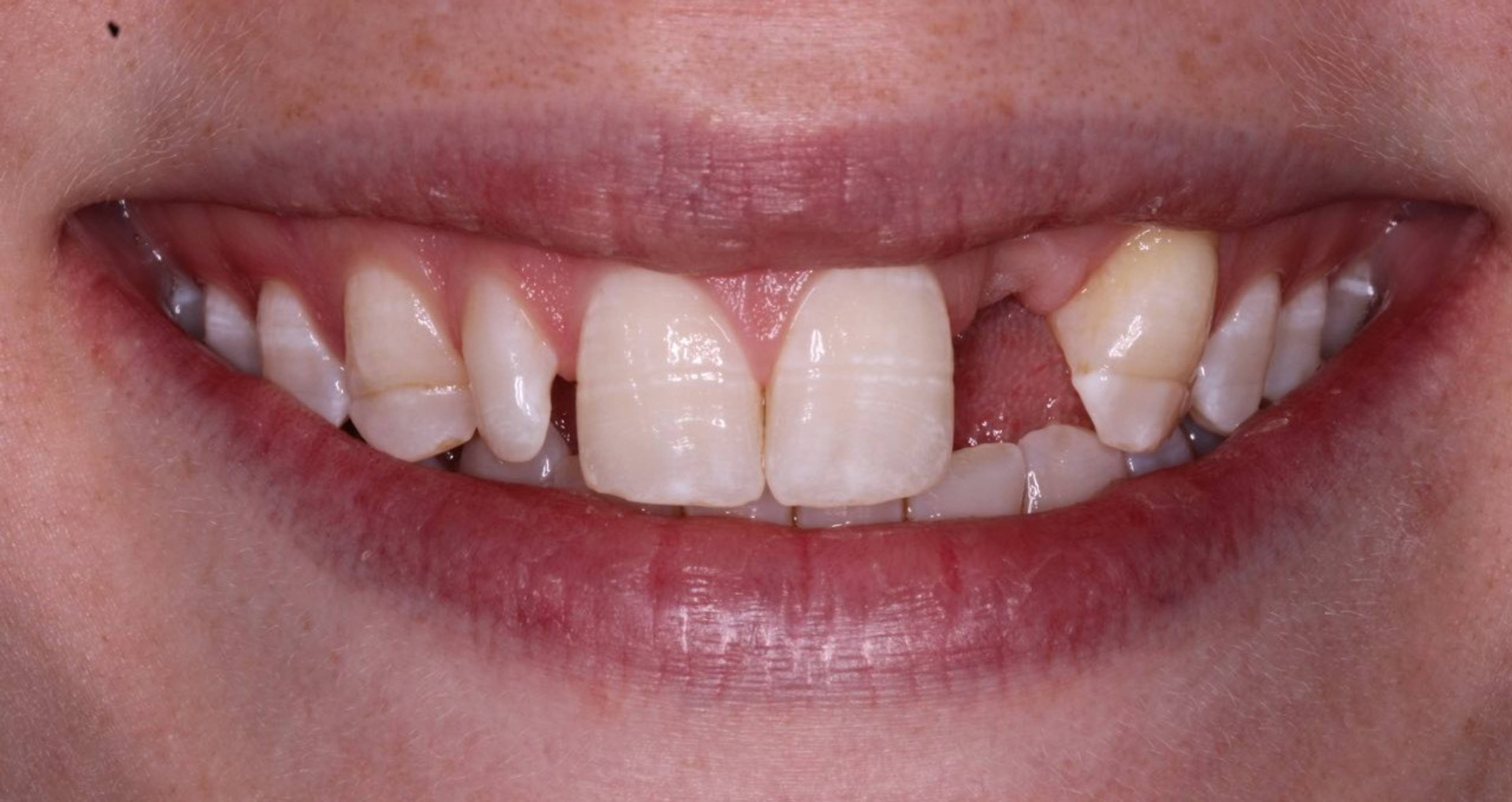 close up of patient smile before single implant treatment missing tooth