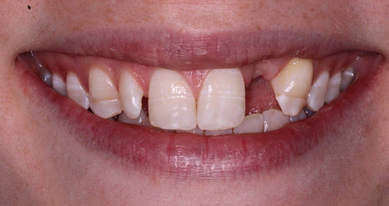 close up of patient smile before single implant treatment missing tooth