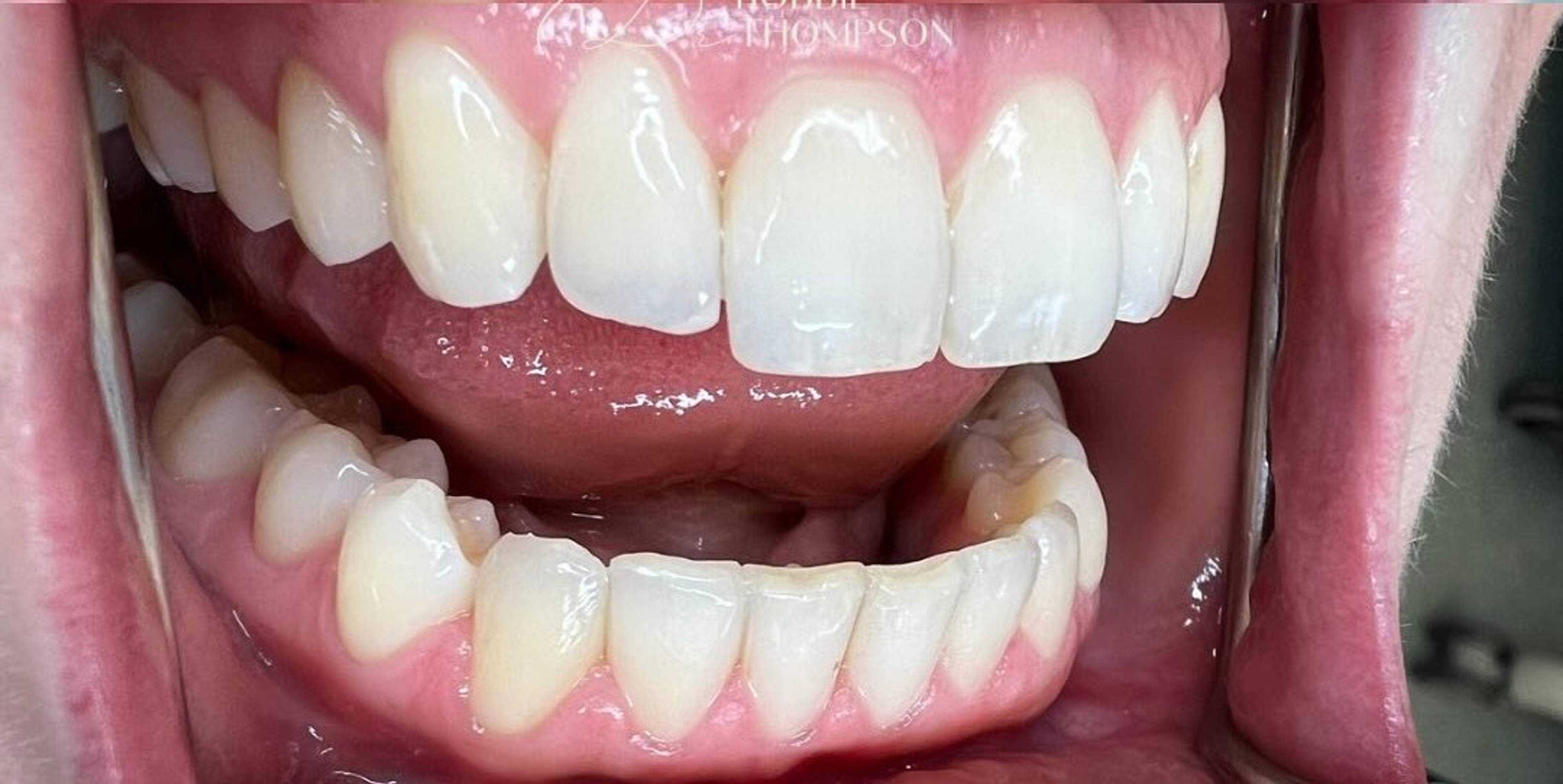 close up of aligned white teeth smiling after invisalign and whitening treatment with Robbie Thompson
