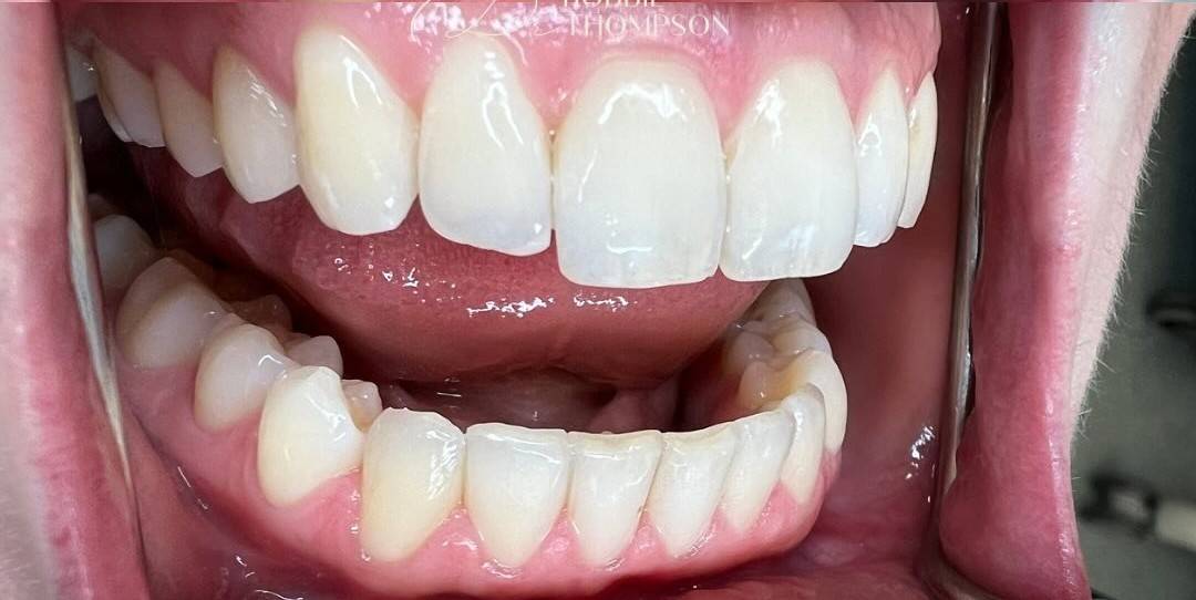 close up of aligned white teeth smiling after invisalign and whitening treatment with Robbie Thompson