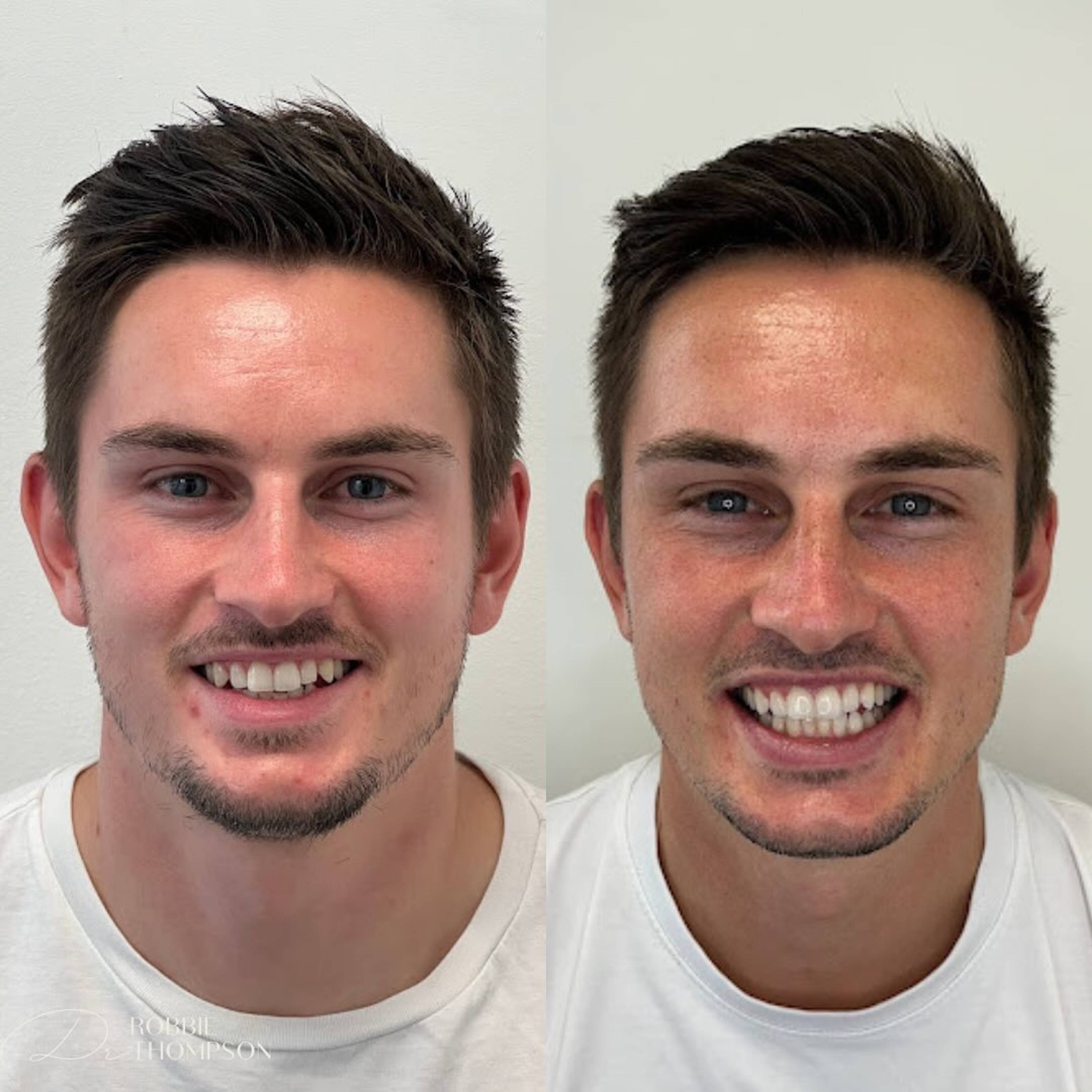 side by side view of patient before and after invisalign and whitening by Robbie Thompson