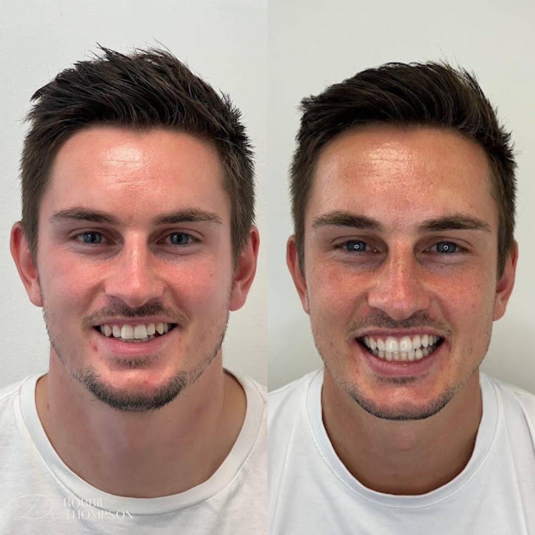 side by side view of patient before and after invisalign and whitening by Robbie Thompson