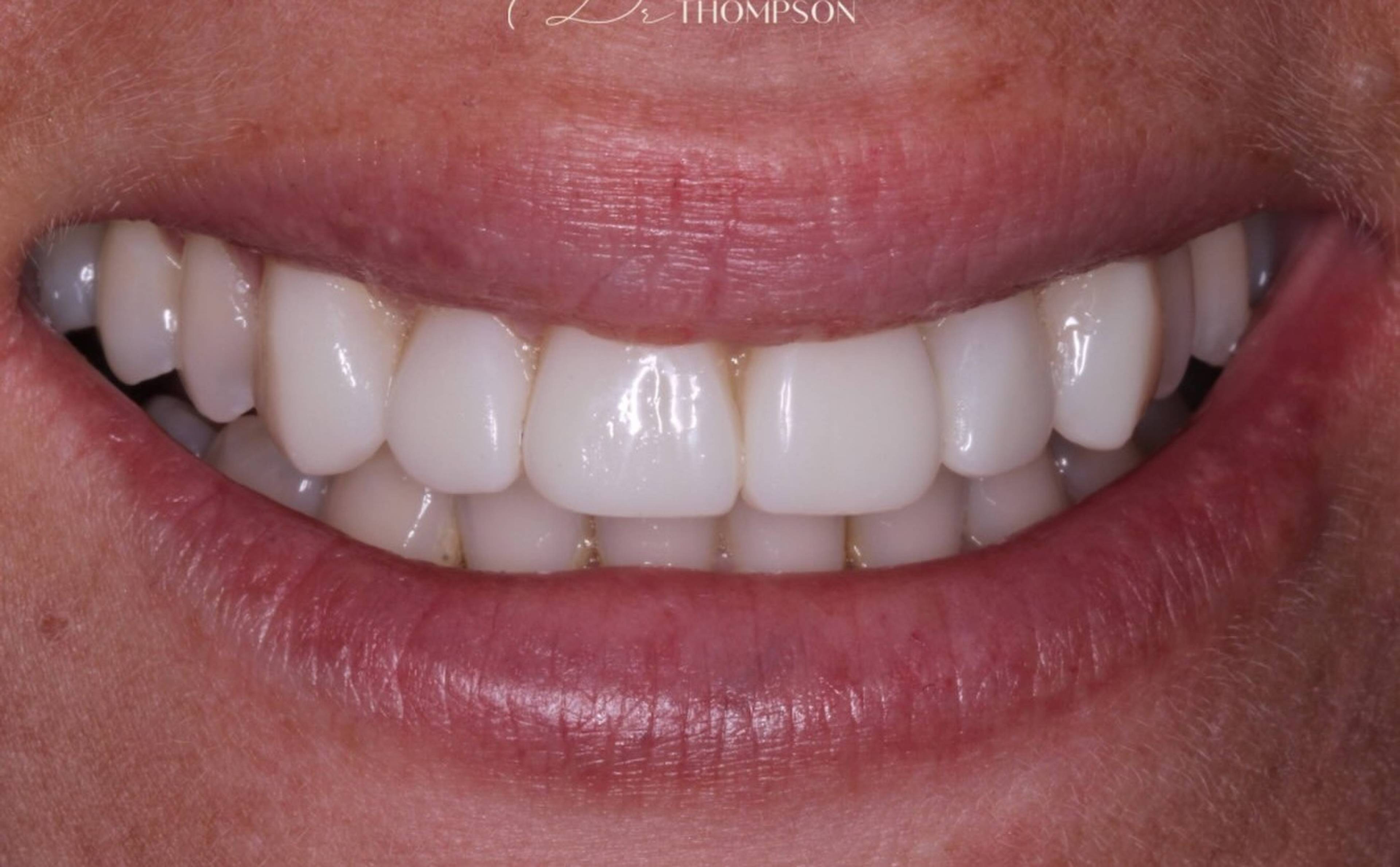 close up smile of teeth after invisalign, whitening, bonding and gum contouring by Robbie Thompson
