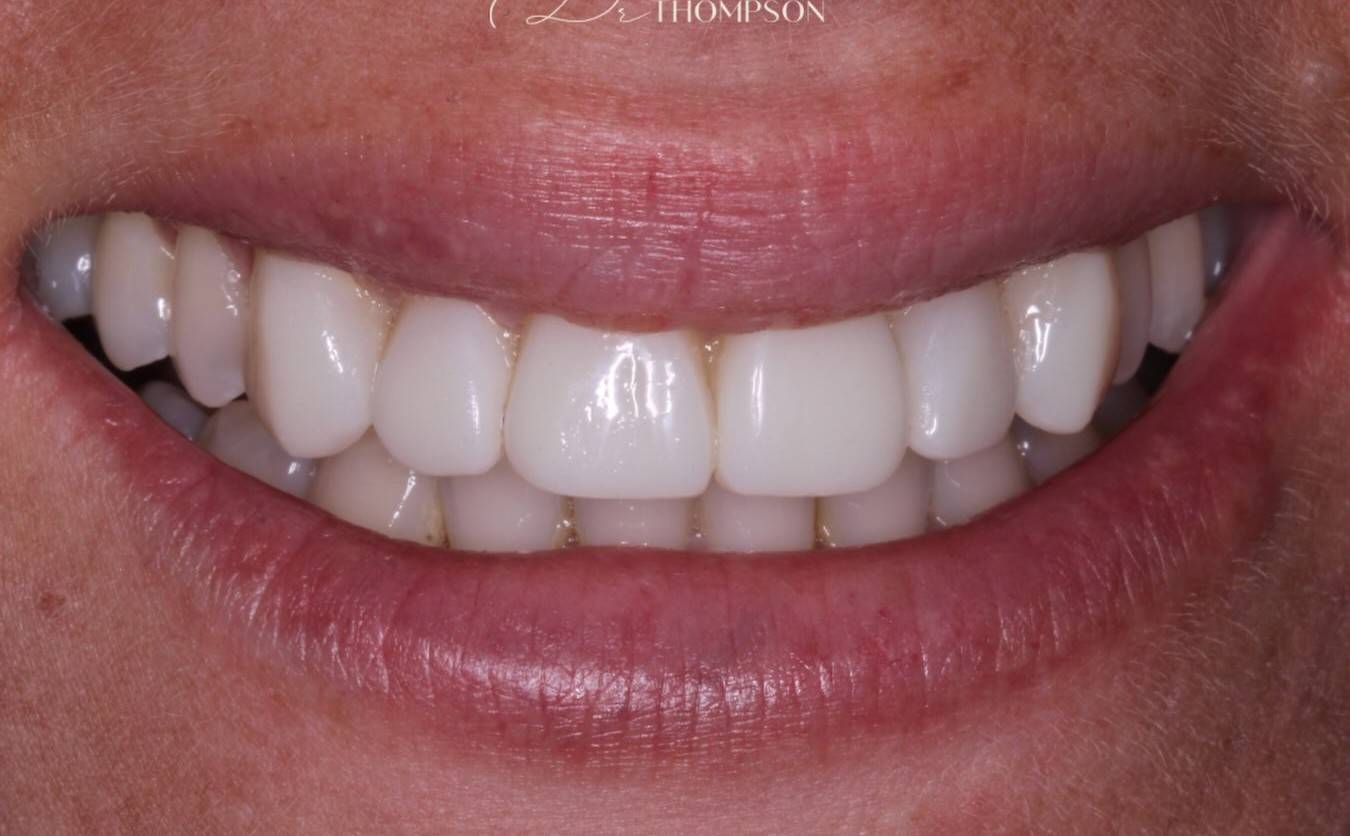close up smile of teeth after invisalign, whitening, bonding and gum contouring by Robbie Thompson