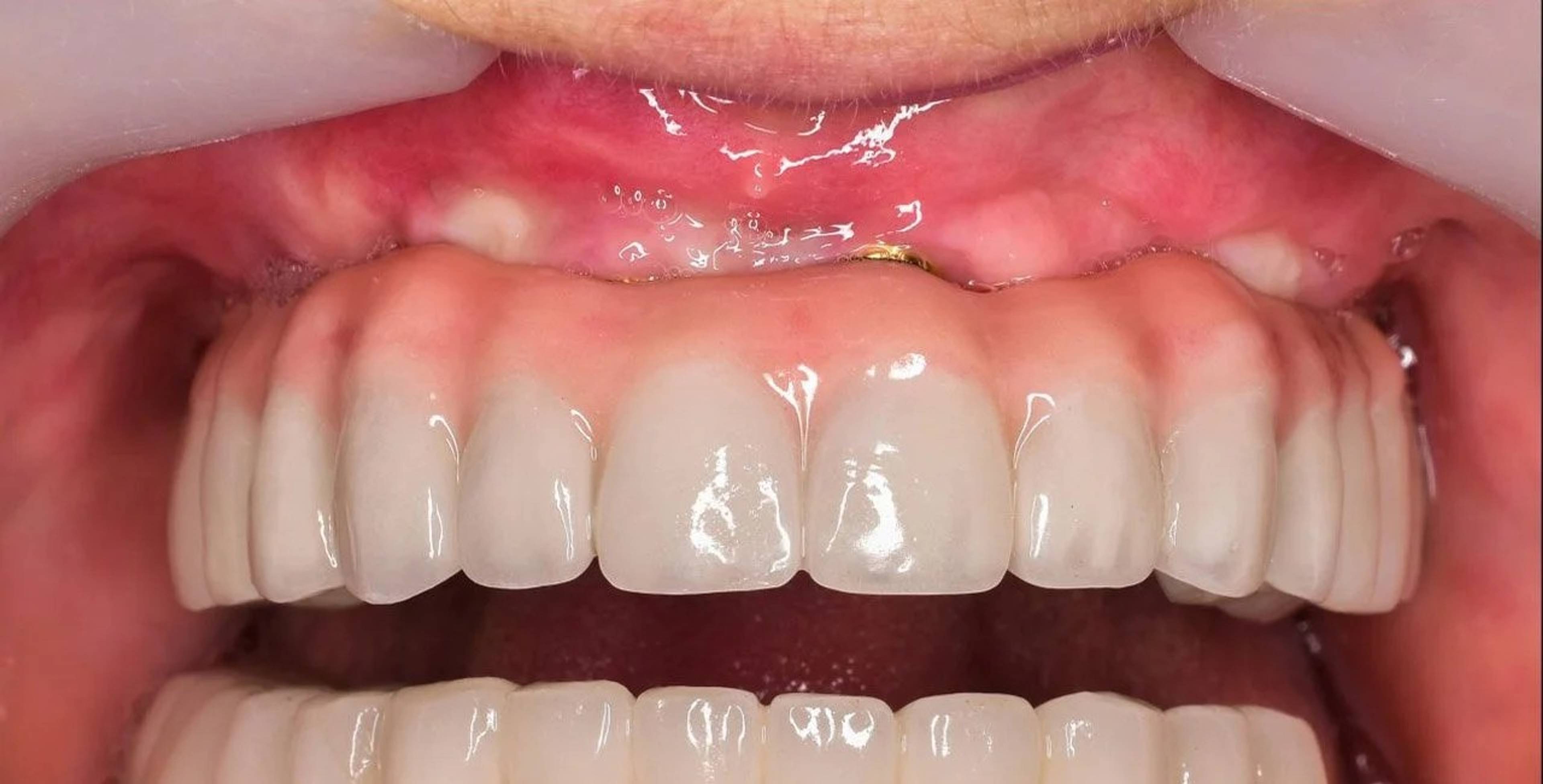 Bath Spa Dentistry full arch implants after