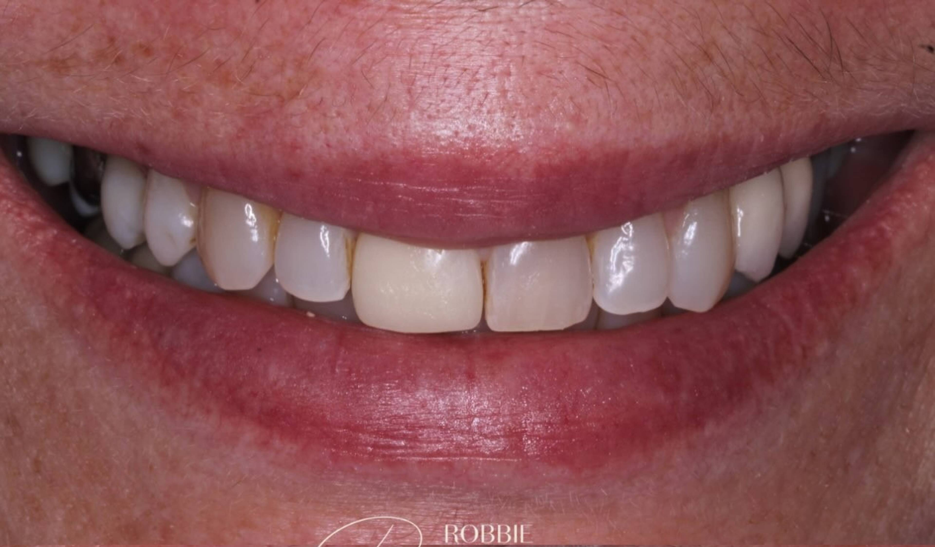 close up of patient smile showing old crown before replacement by Robbie Thompson