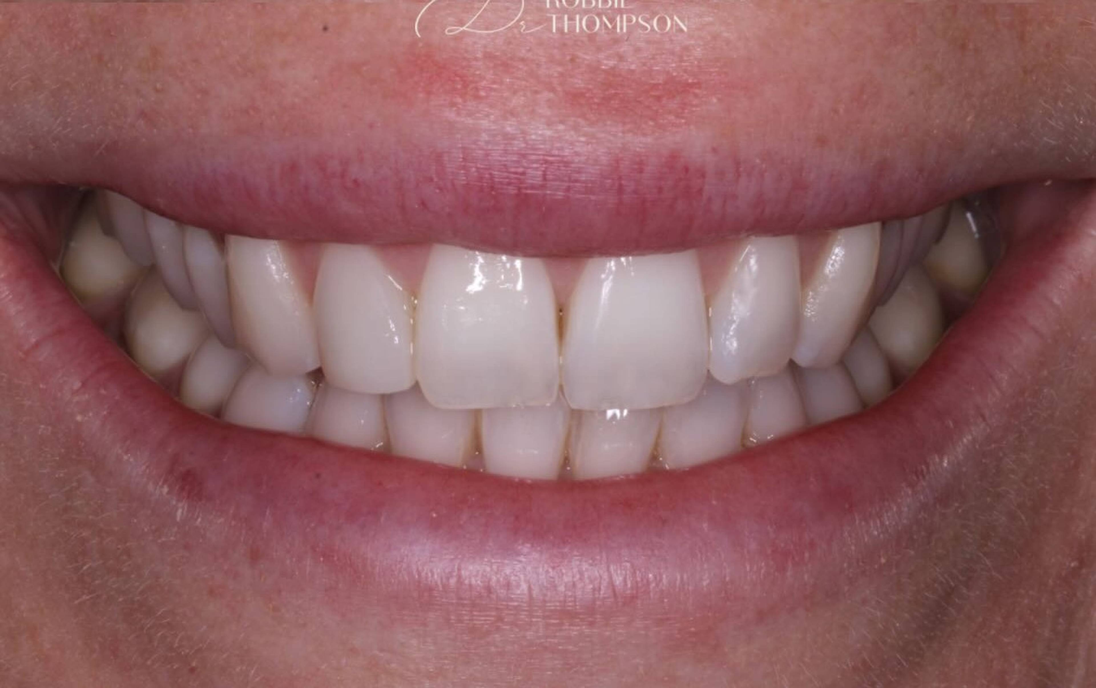 after subtle edge composite bonding by Robbie Thompson 