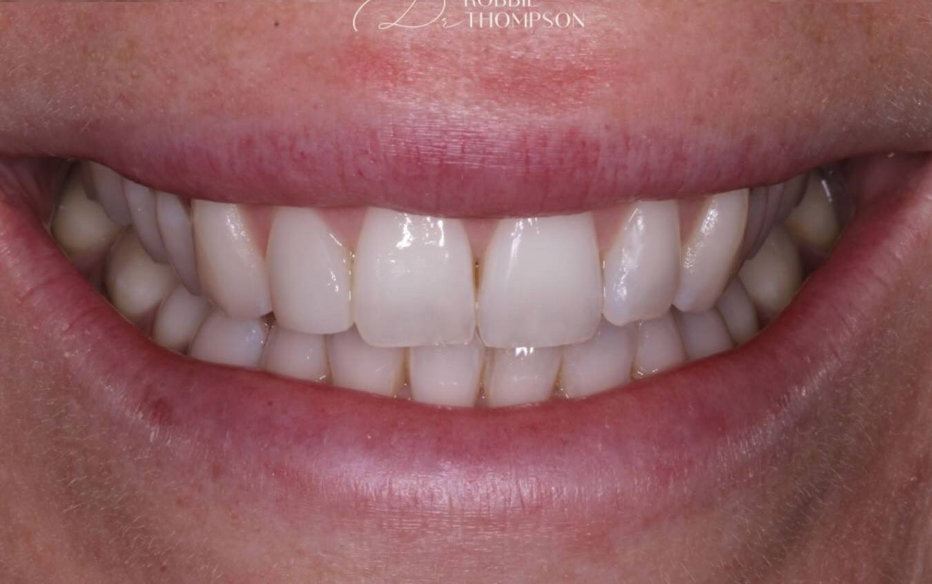after subtle edge composite bonding by Robbie Thompson