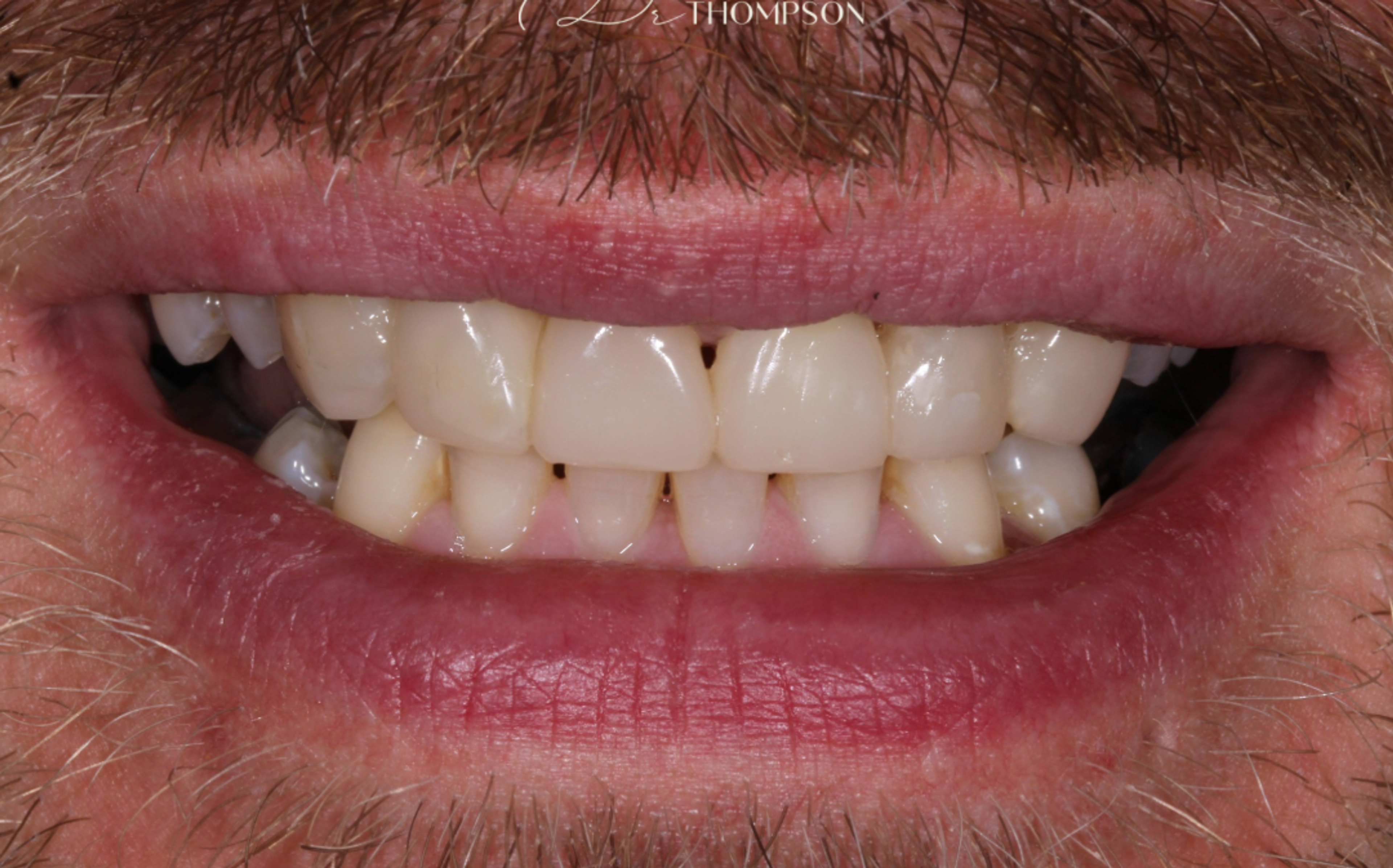 after composite bonding with full smile and aligned teeth by Robbie Thompson