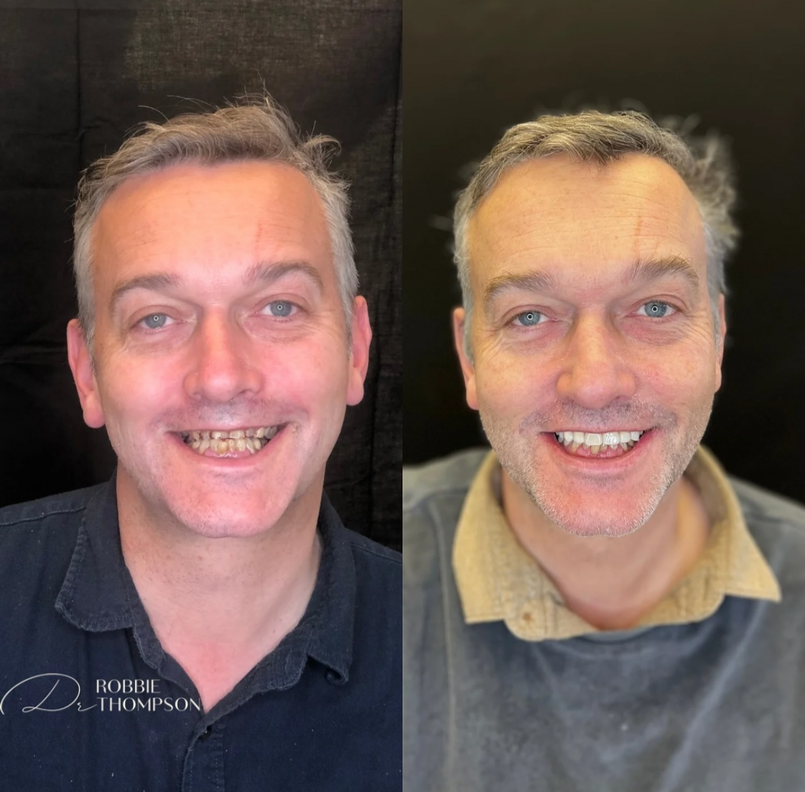 Before and after transformative results for dental crowns for middle aged patient side by side amazing results
