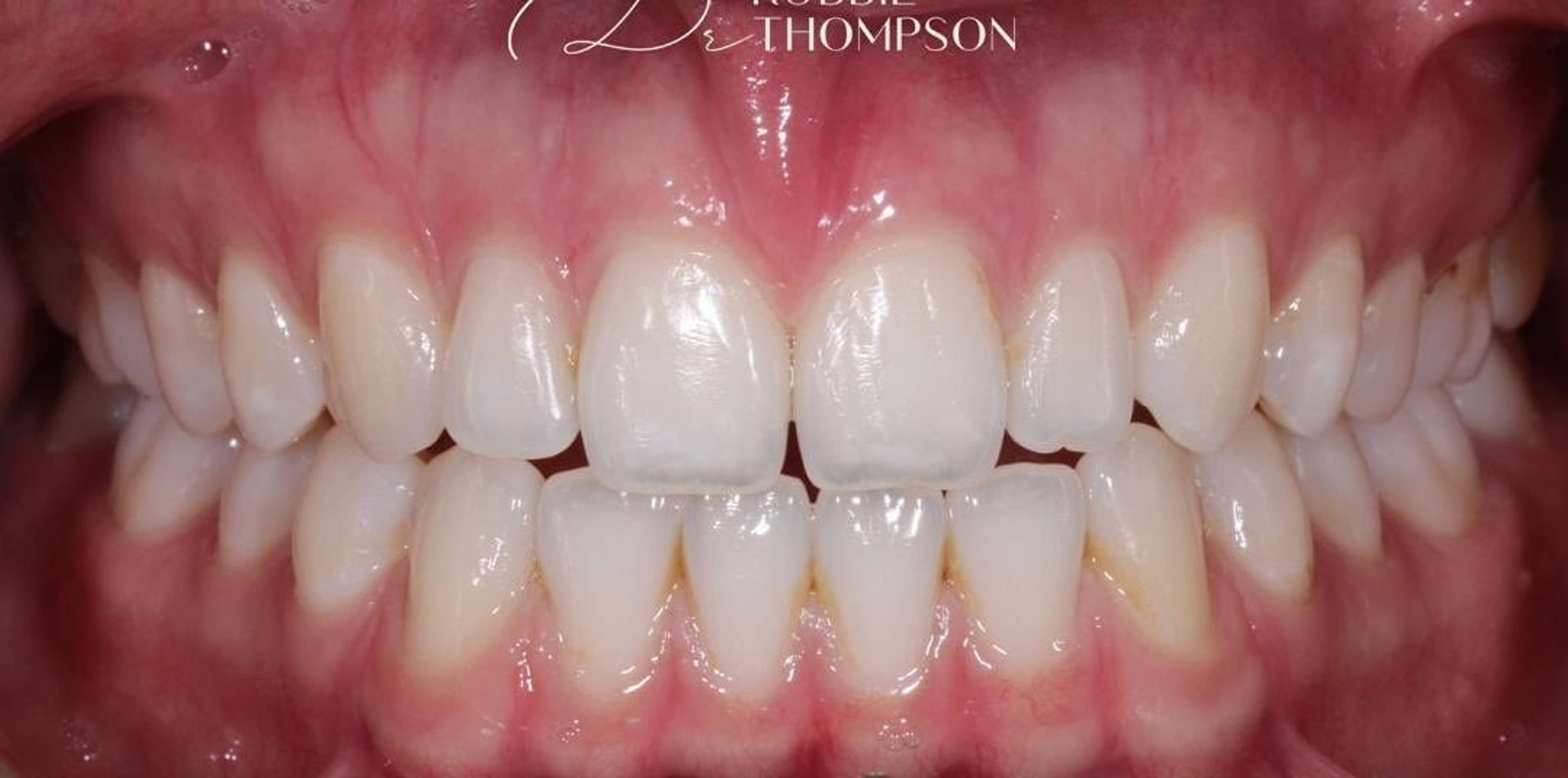 close up of patients smile without gaps after invisalign treatment aligning and widening this patients smile by Robbie Thompson