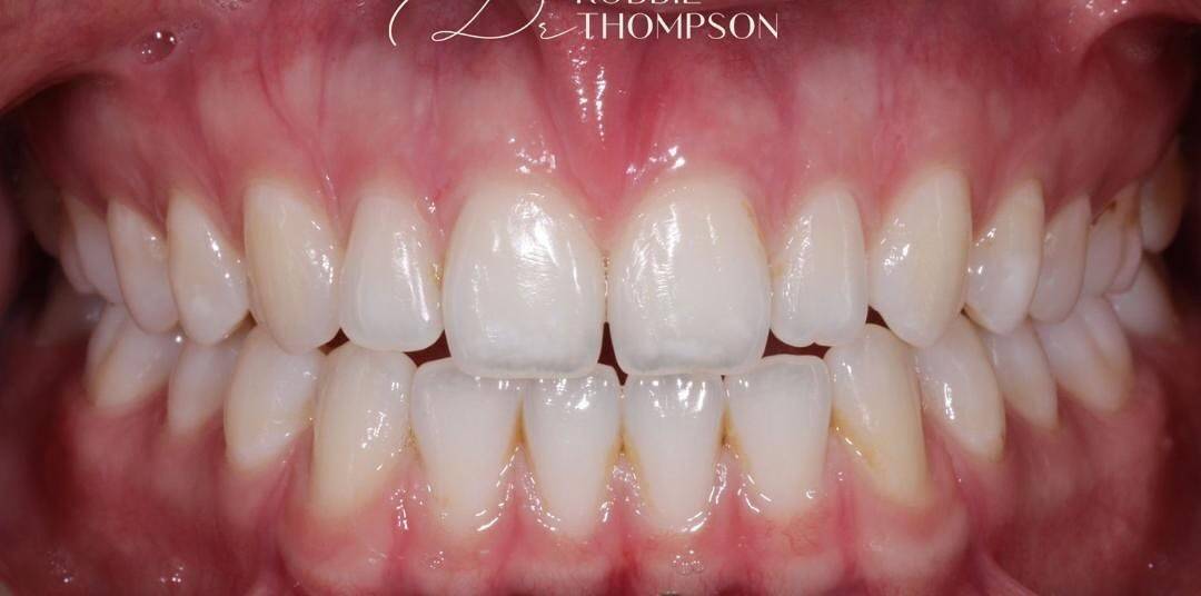 close up of patients smile without gaps after invisalign treatment aligning and widening this patients smile by Robbie Thompson