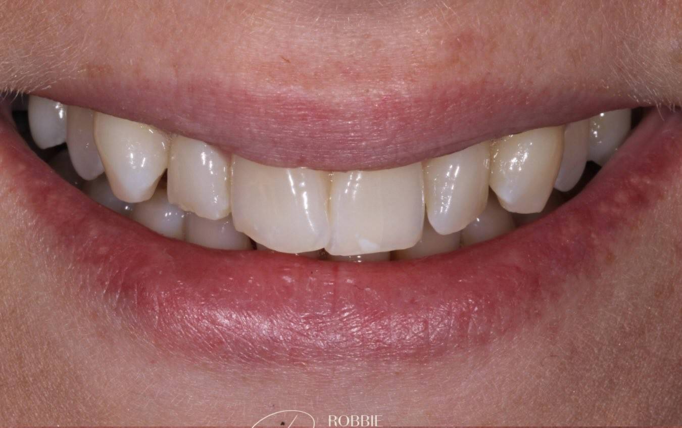 close up smile of teeth before invisalign, whitening, bonding and gum contouring by Robbie Thompson