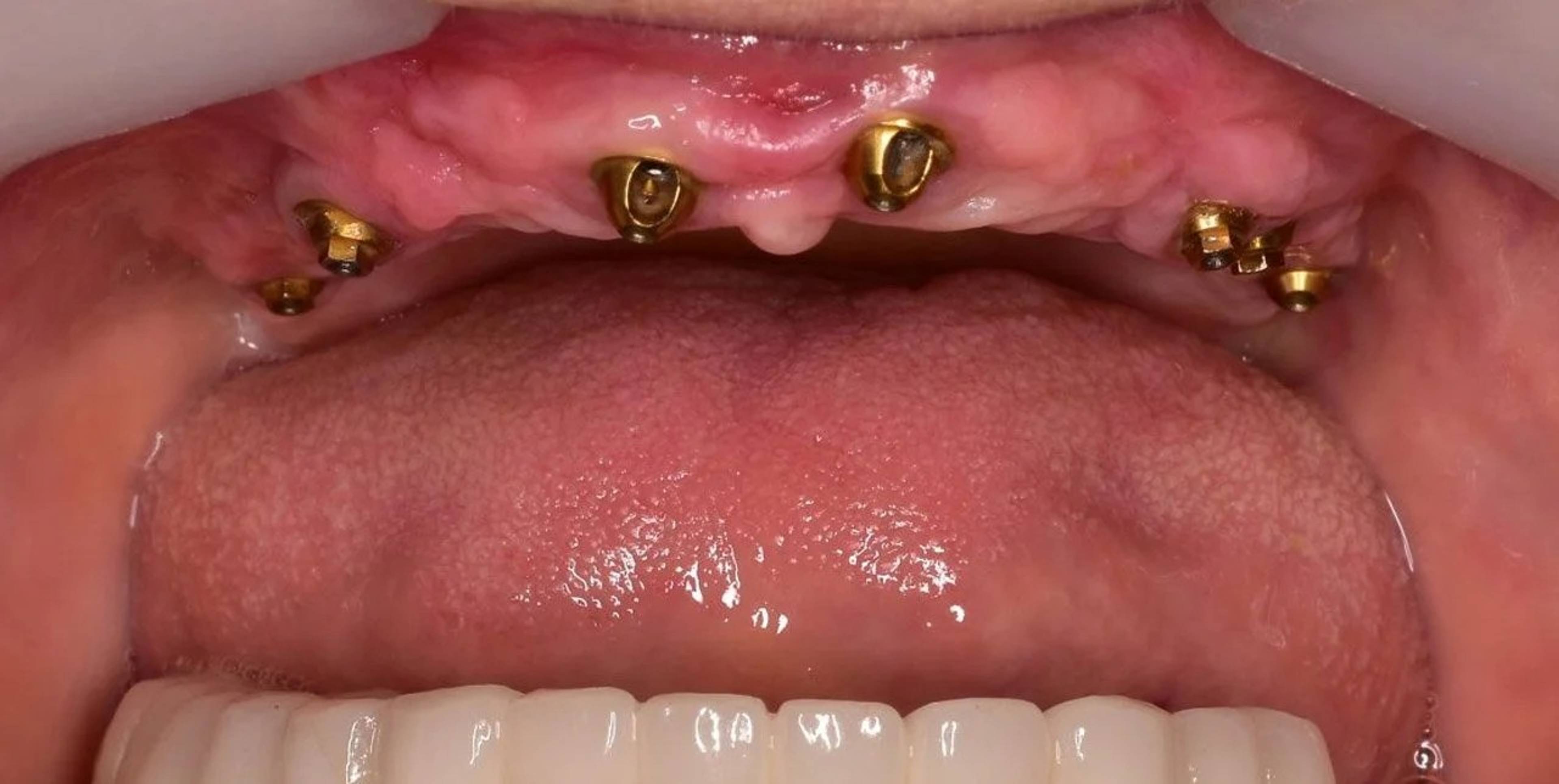 Bath spa dentistry full arch implants before