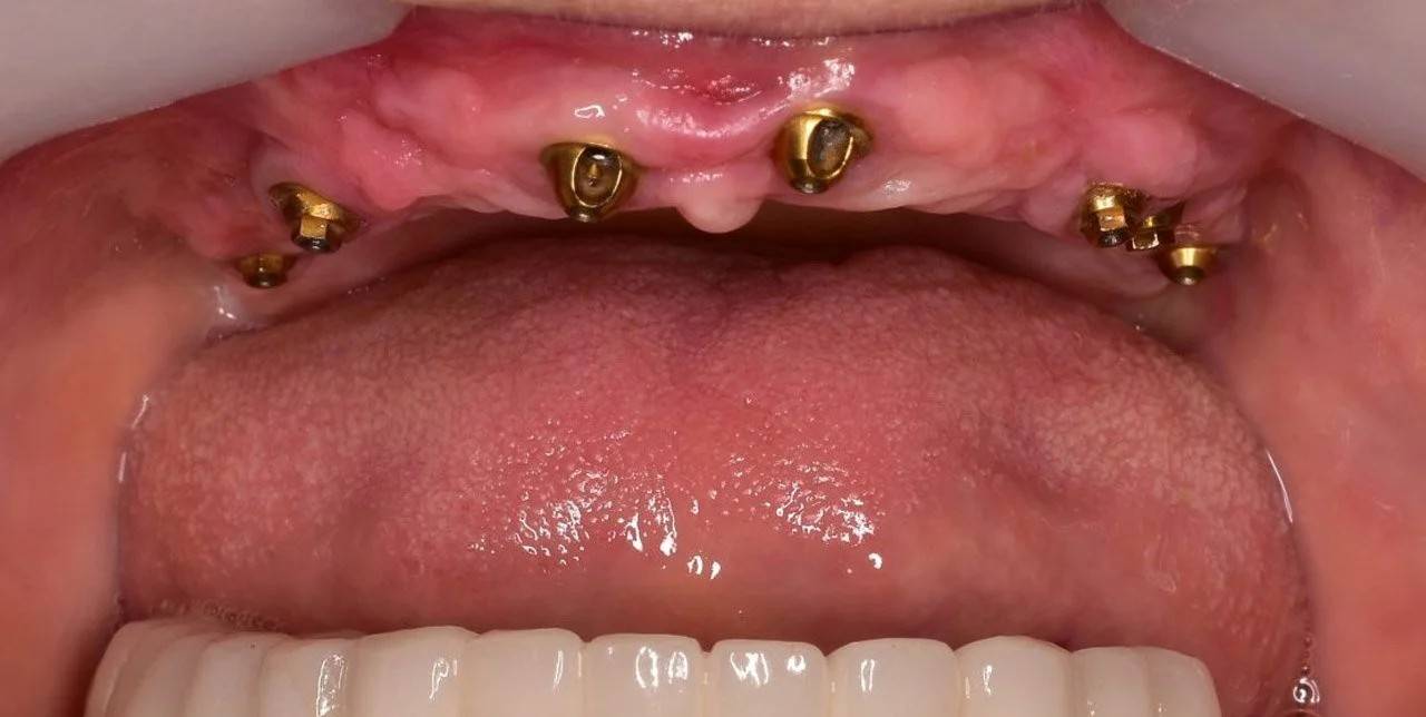 Bath spa dentistry full arch implants before