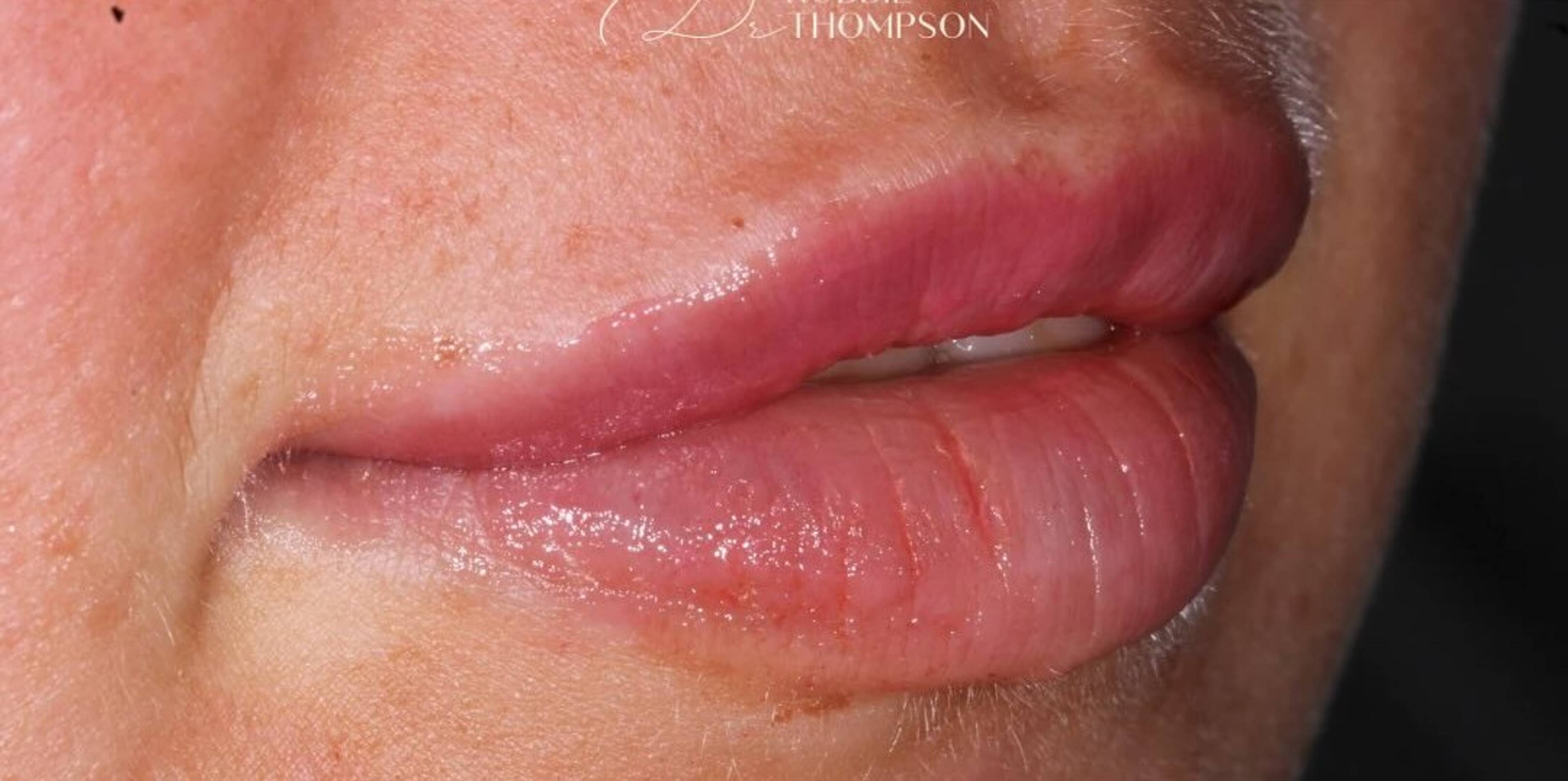close up of patient lips after subtle lip filler treatment by Robbie Thompson