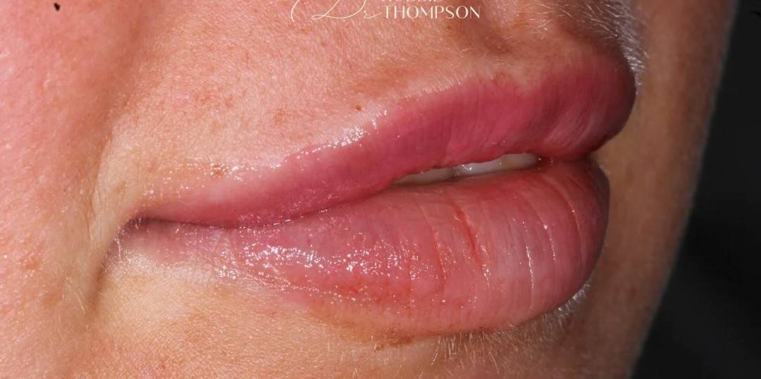 close up of patient lips after subtle lip filler treatment by Robbie Thompson