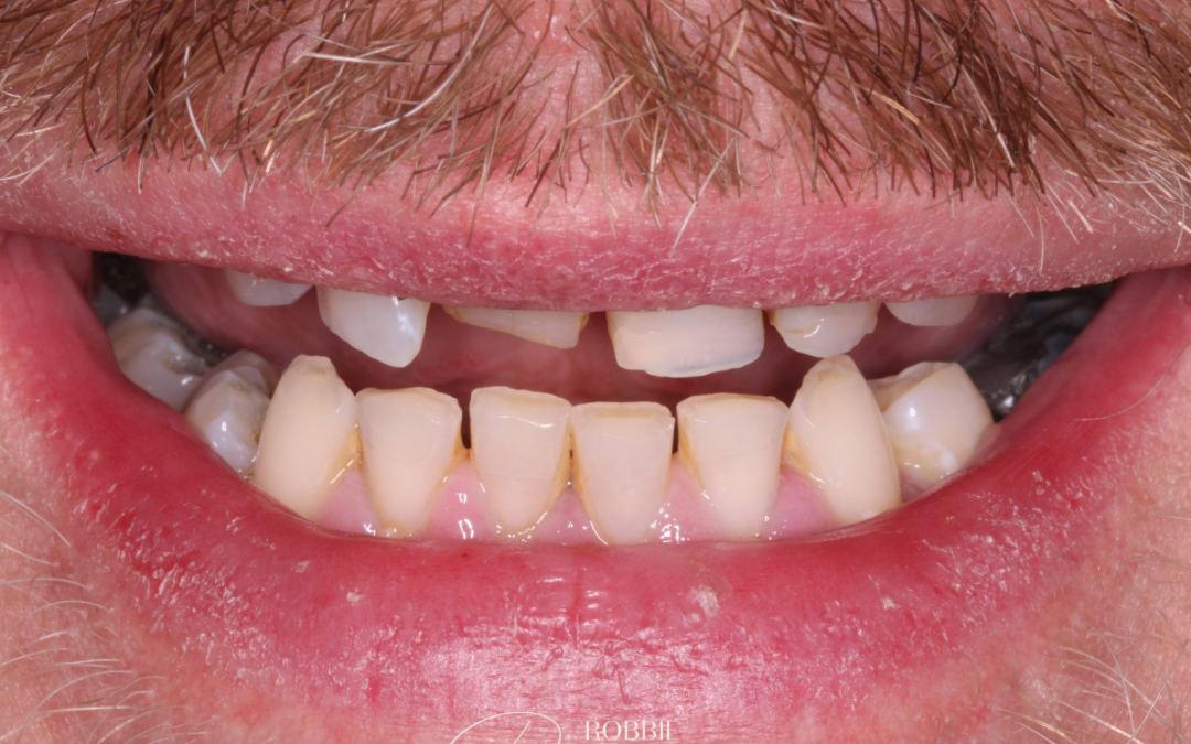 before composite bonding treatment showing misaligned teeth and gaps in smile by Robbie Thompson