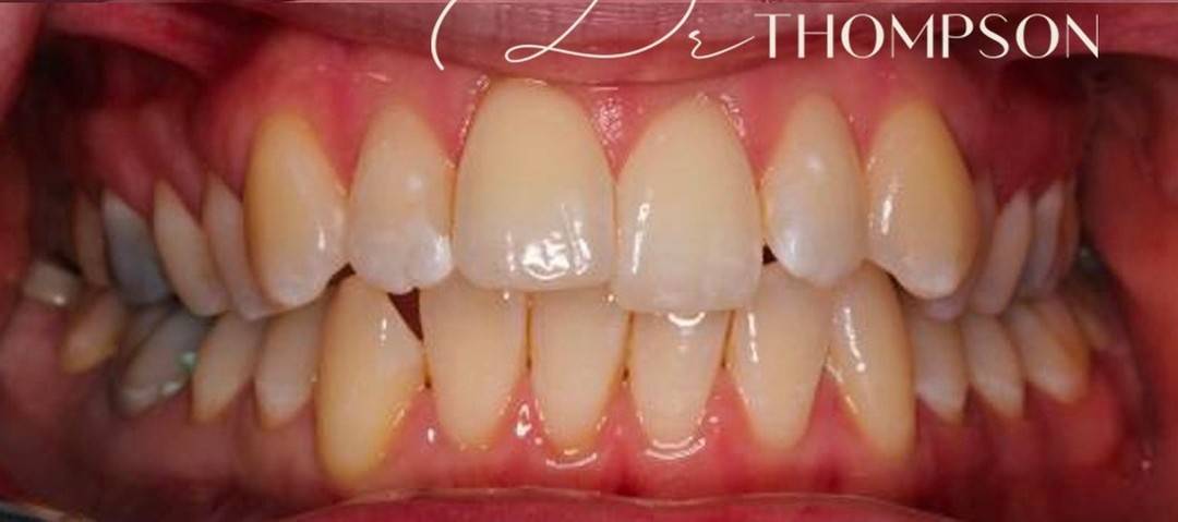 close up of teeth crossed over and slightly stained before treatment with Robbie Thompson