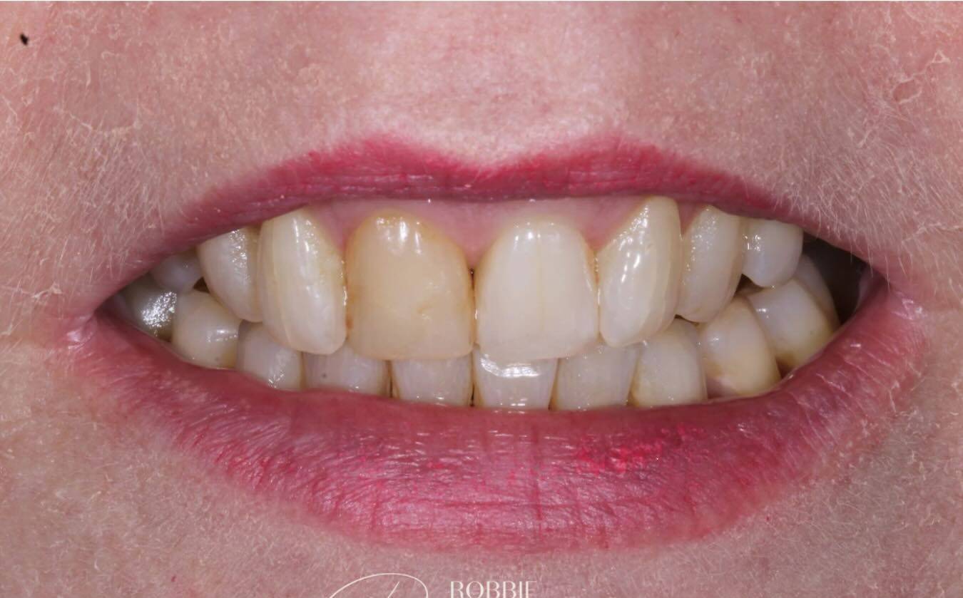 before single tooth composite bonding by Robbie Thompson