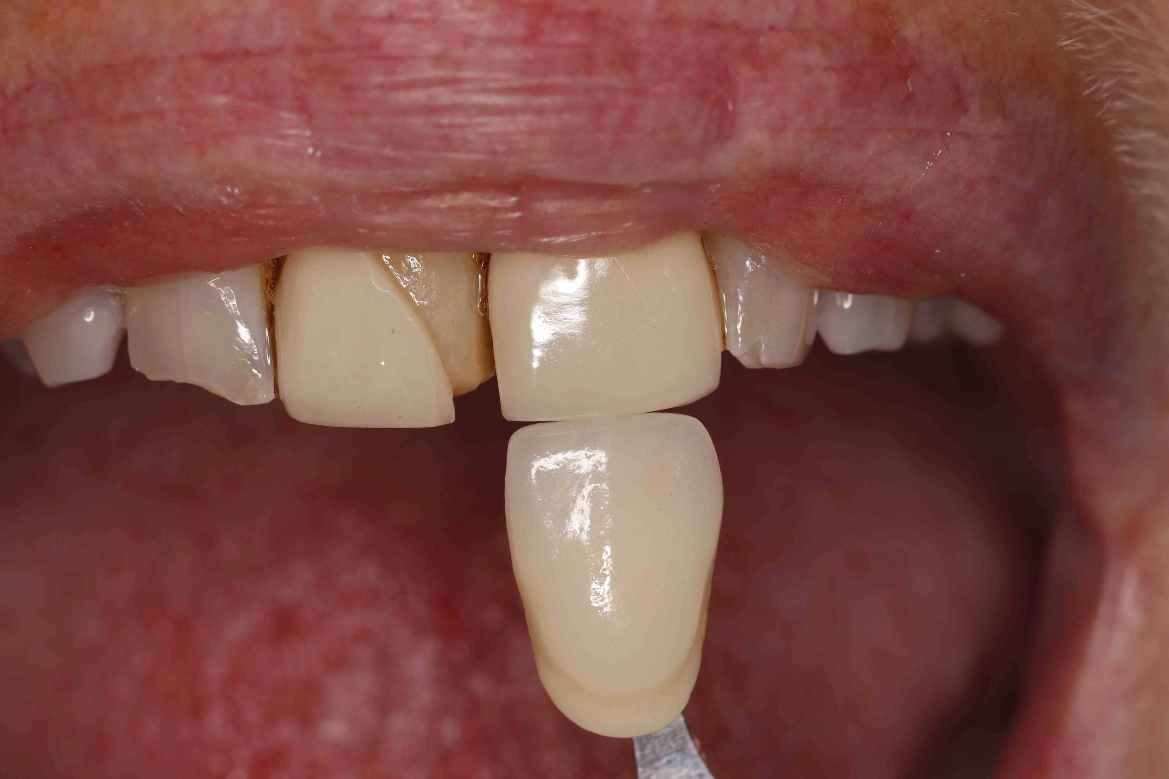 veneers before image