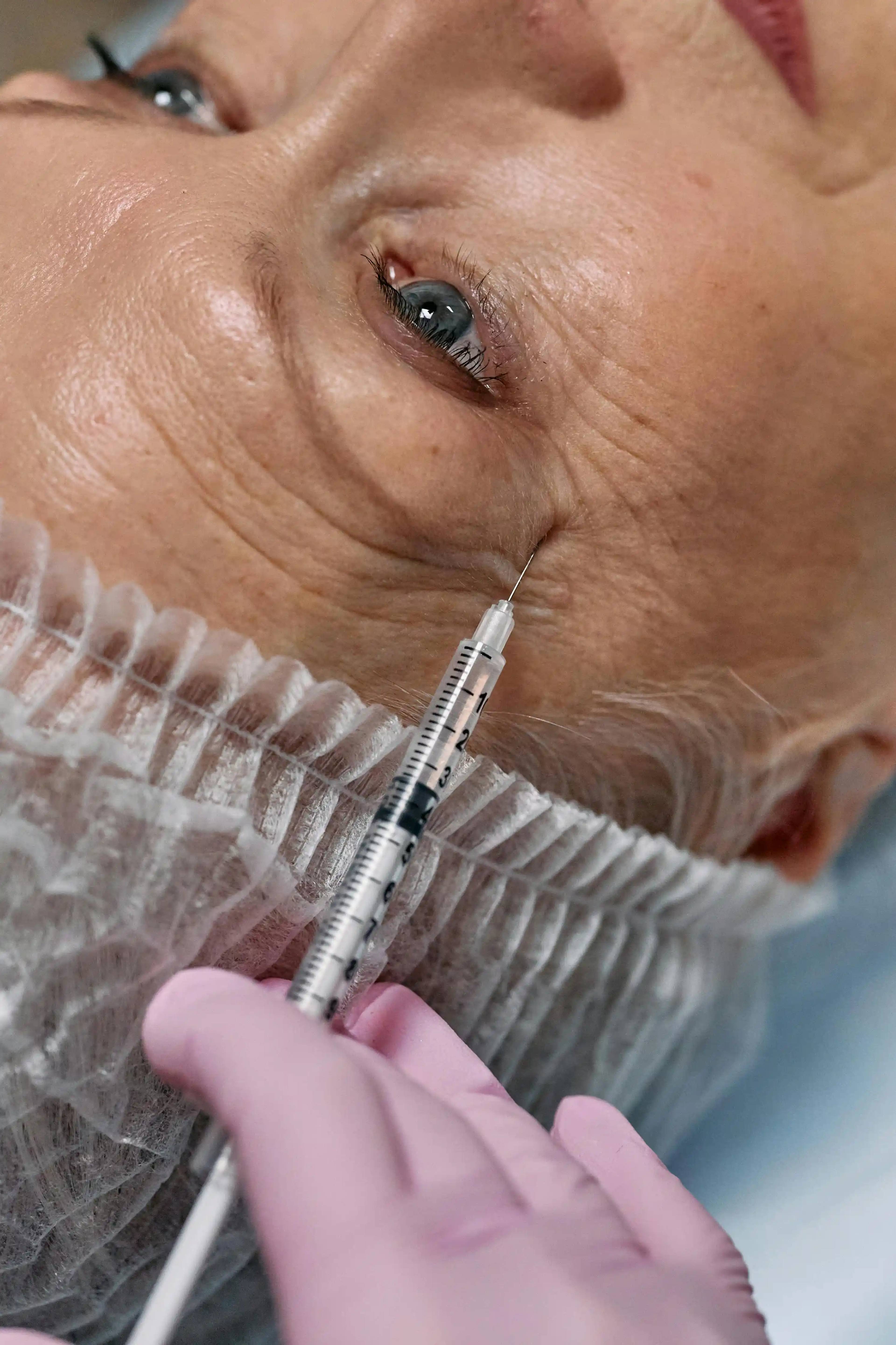 Close-up of a facial aesthetics treatment with an injectable procedure being administered near the outer eye area at Bath Spa Dentistry.