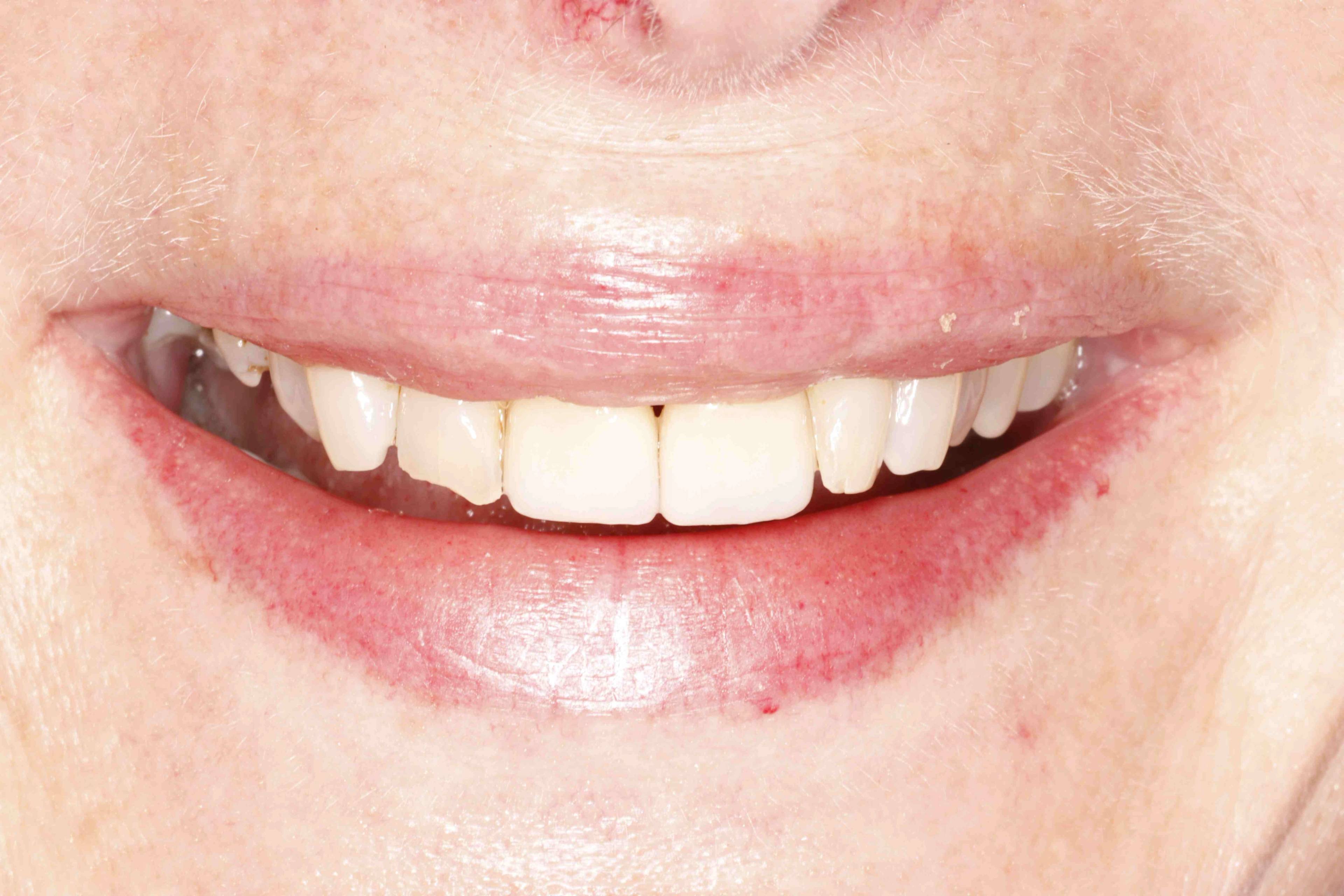 Does vaping stain your teeth?
