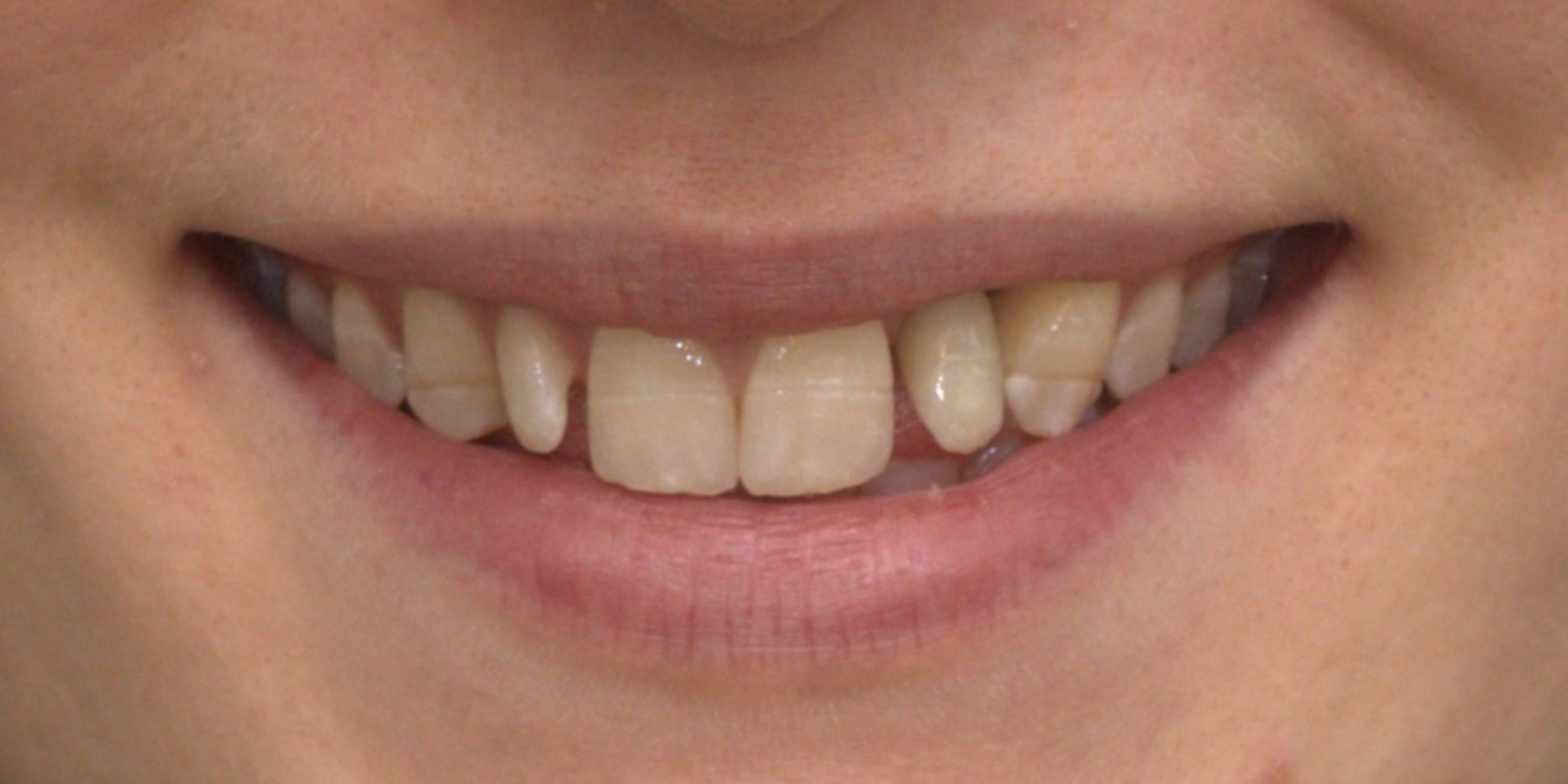 close up of patient smile after single implant treatment 