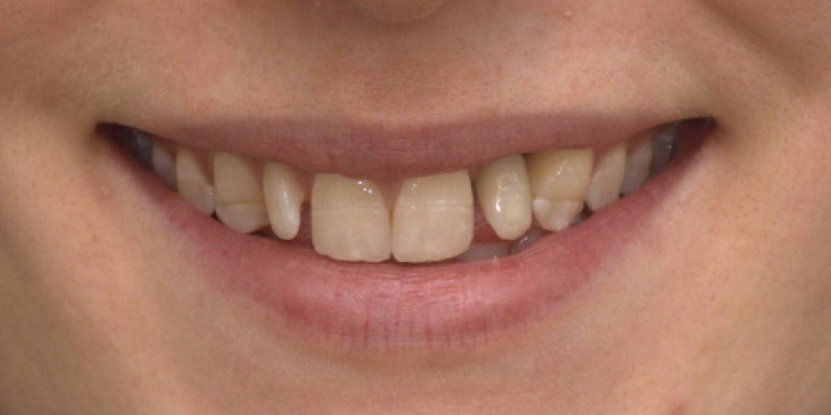 close up of patient smile after single implant treatment