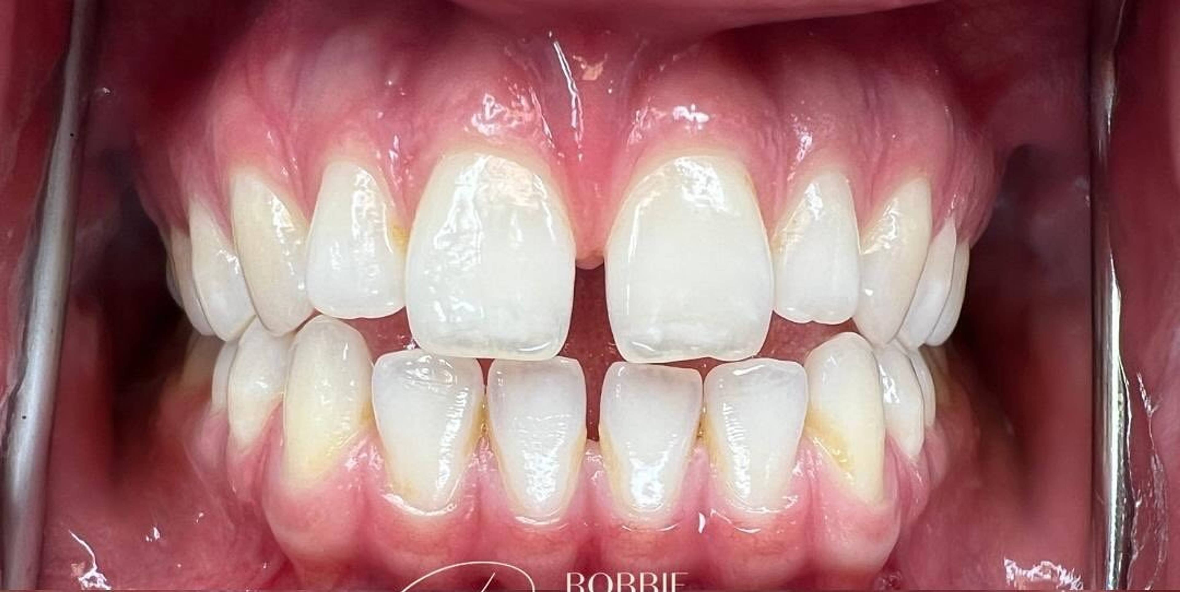 close up of smile with narrow arch and gaps in front teeth before invisalign treatment with Robbie Thompson