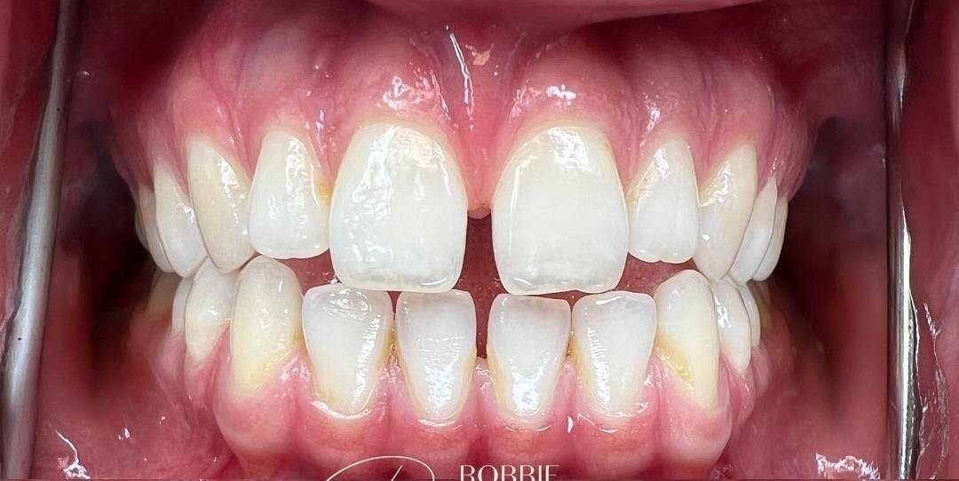 close up of smile with narrow arch and gaps in front teeth before invisalign treatment with Robbie Thompson