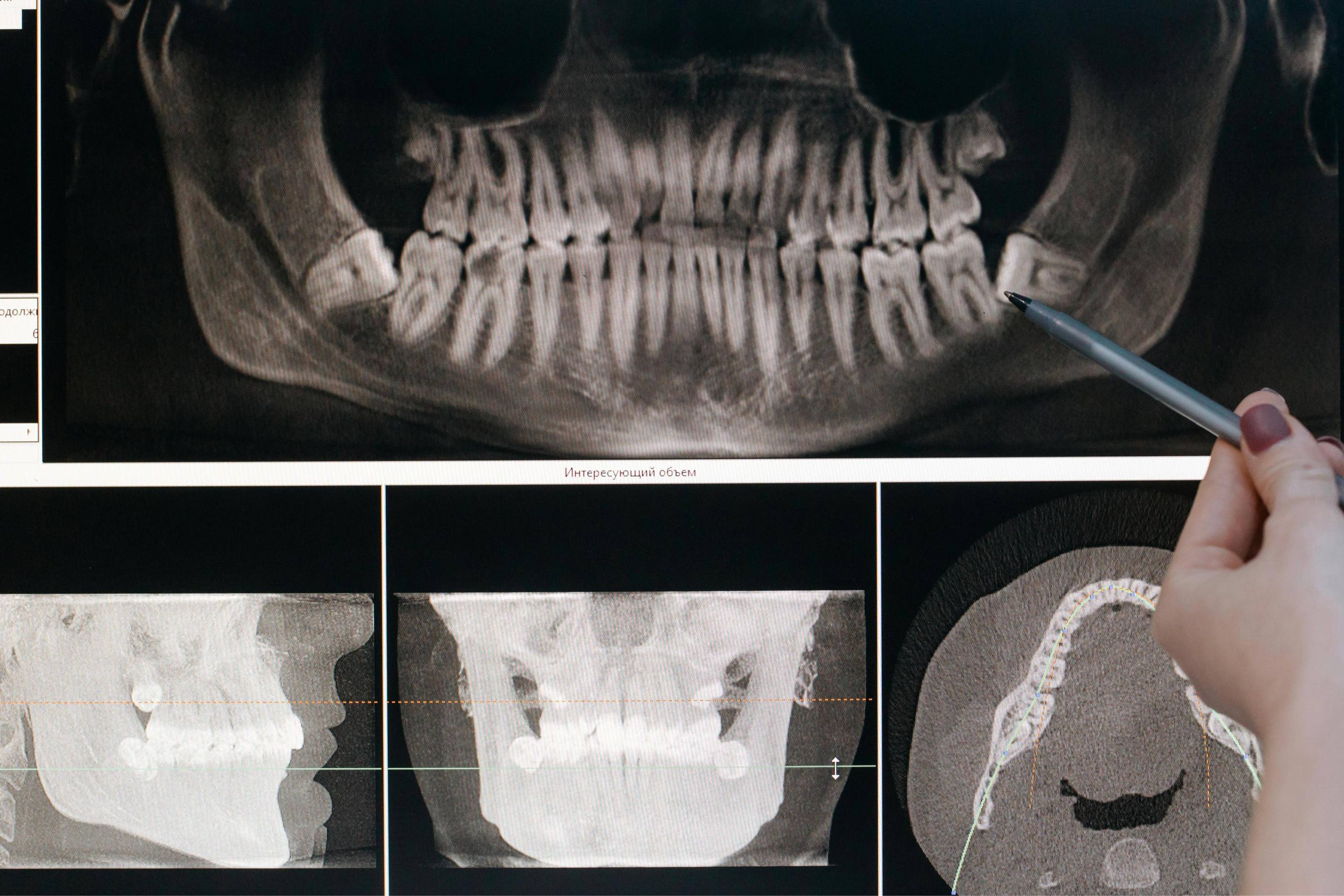 Close up of dentist hand holding a pen and pointing at a full mouth OPG x-ray showing an impacted wisdom tooth stock photo