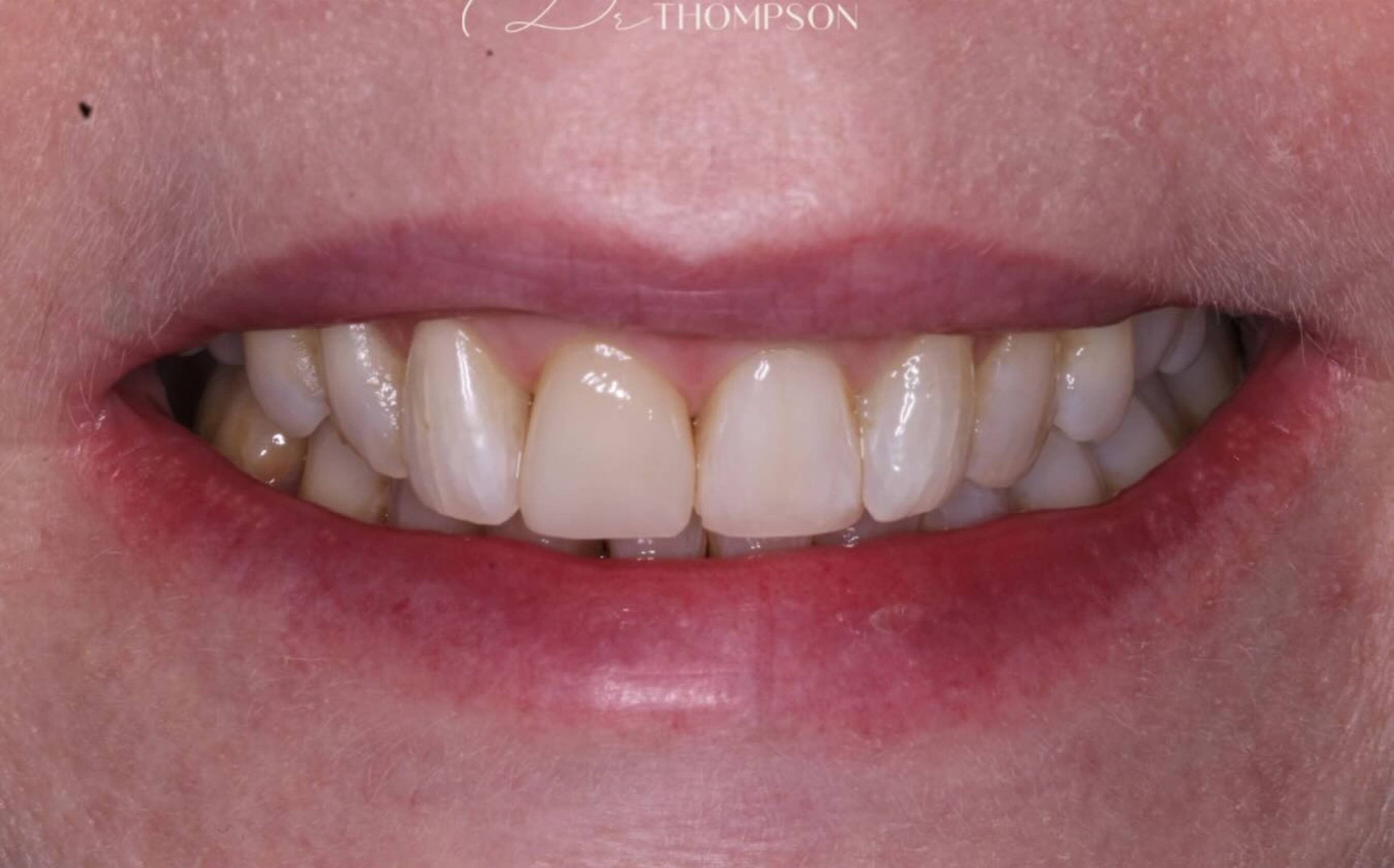 after single tooth composite bonding by Robbie Thompson 