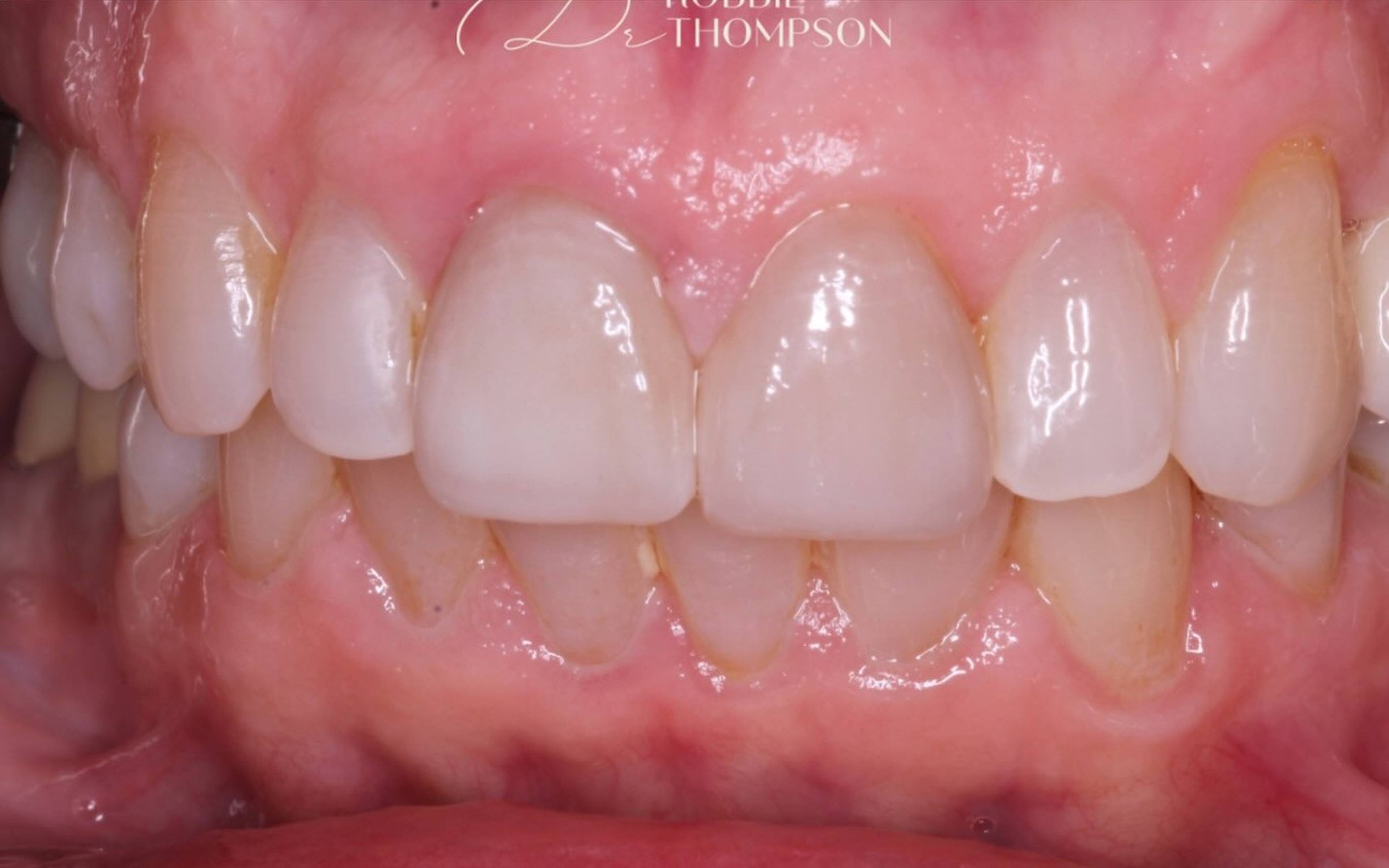after crown and veneer treatment by Robbie Thompson