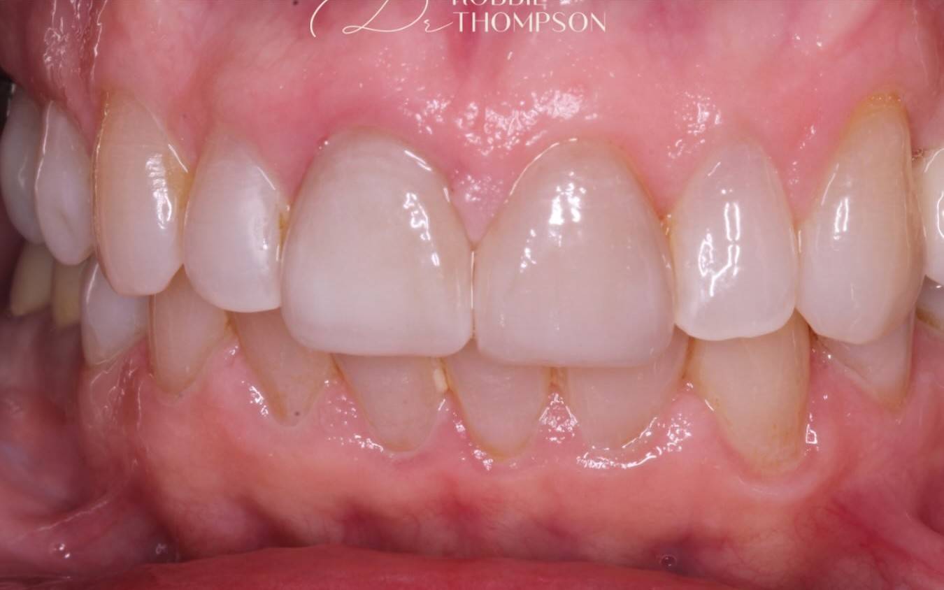 after crown and veneer treatment by Robbie Thompson