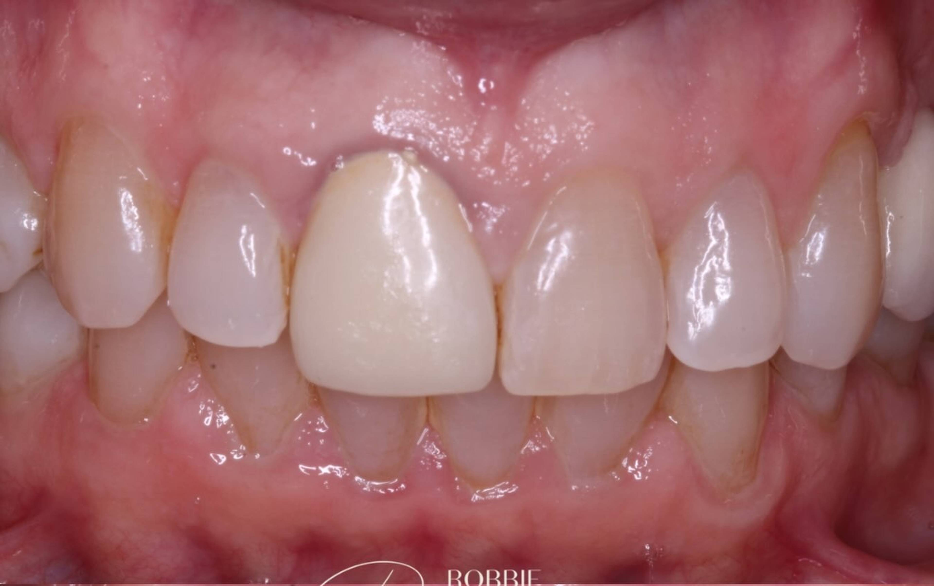before crown replacement and veneer by Robbie Thompson