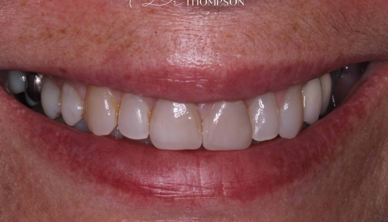 close up of patient smile after treatment of new dental crown and veneer with natural results by Robbie Thompson