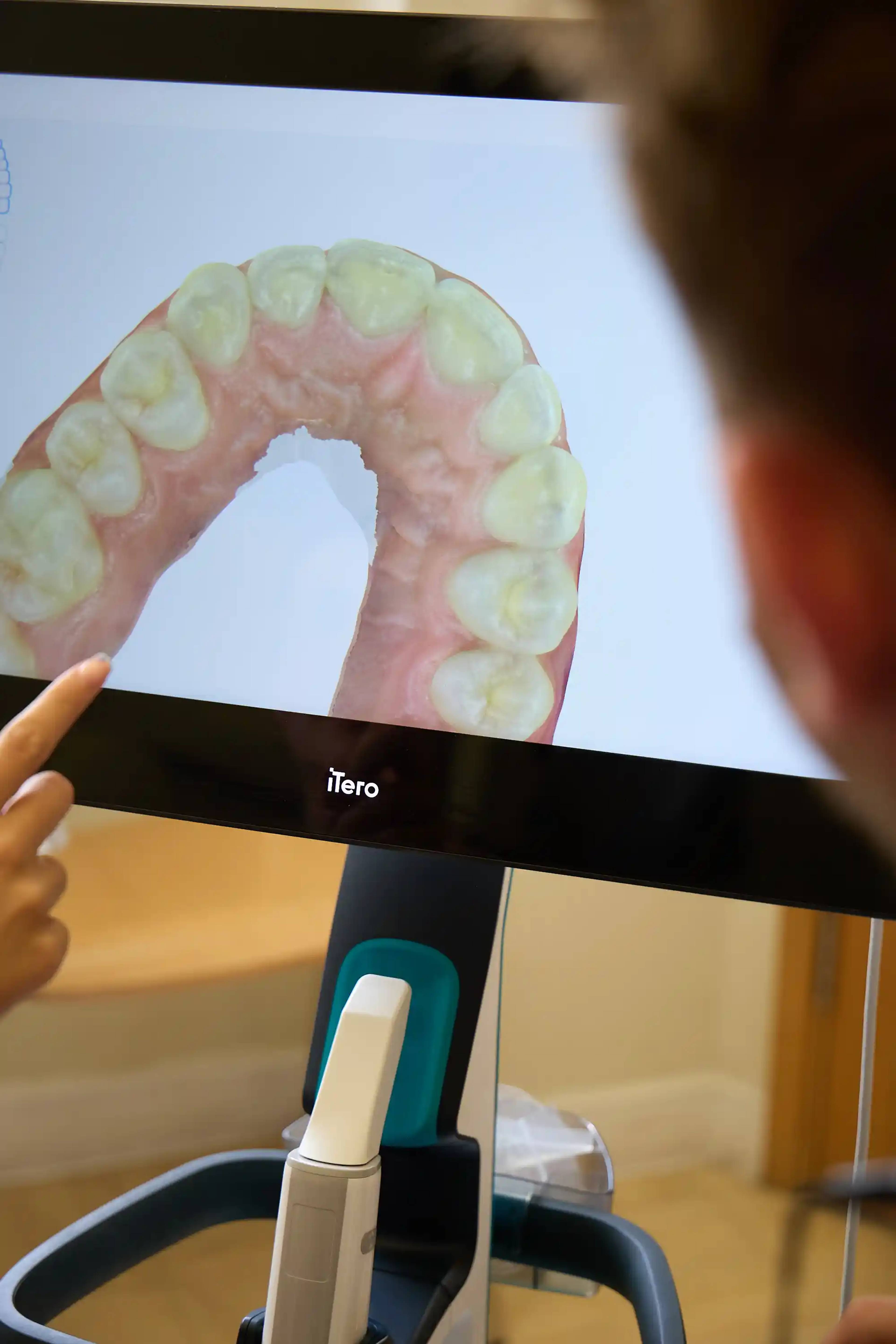 Patient reviewing a 3D digital scan of teeth on an iTero scanner display during a consultation at Bath Spa Dentistry.