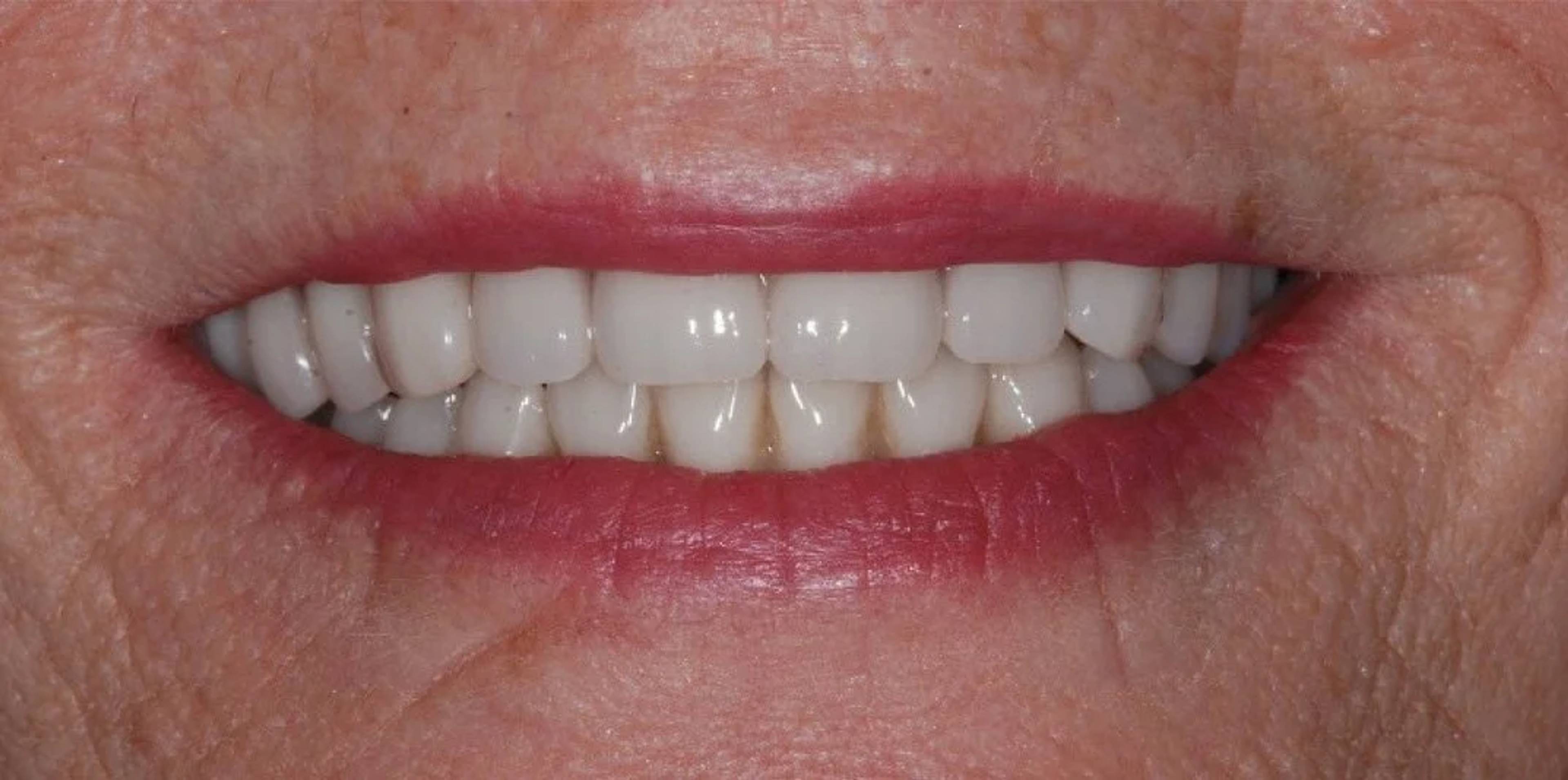 Bath spa dentistry same day teeth implants after
