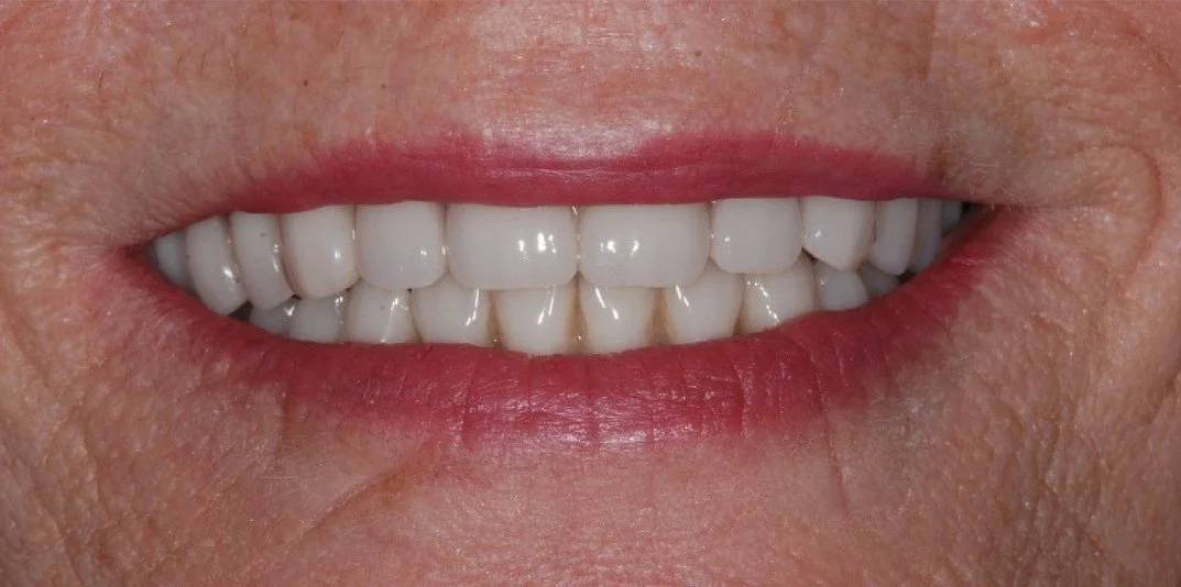 Bath spa dentistry same day teeth implants after