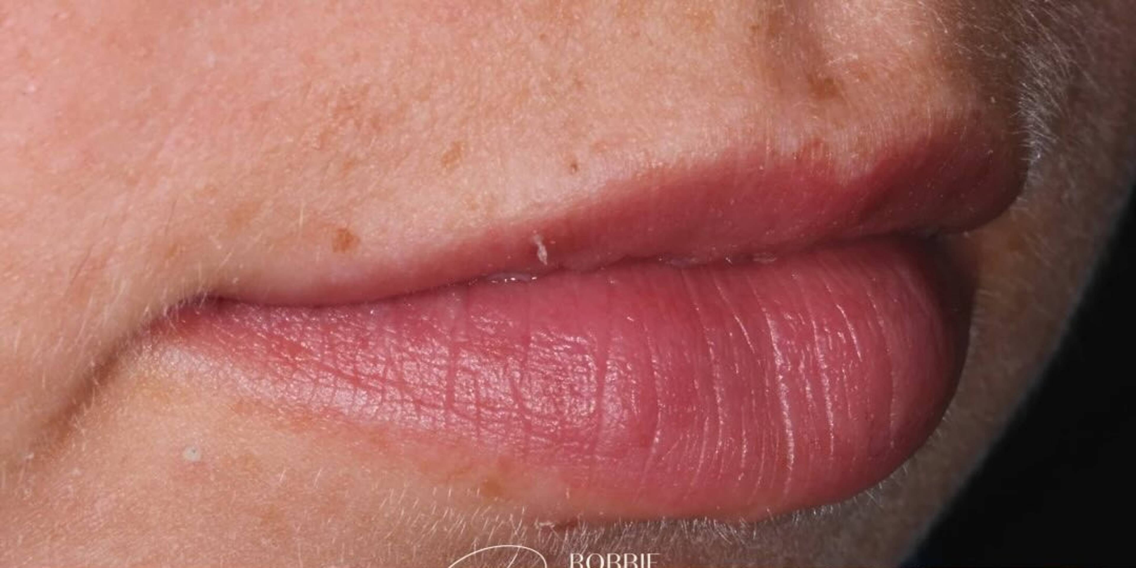 close up of patient lips natural before lip filler treatment by Robbie Thompson