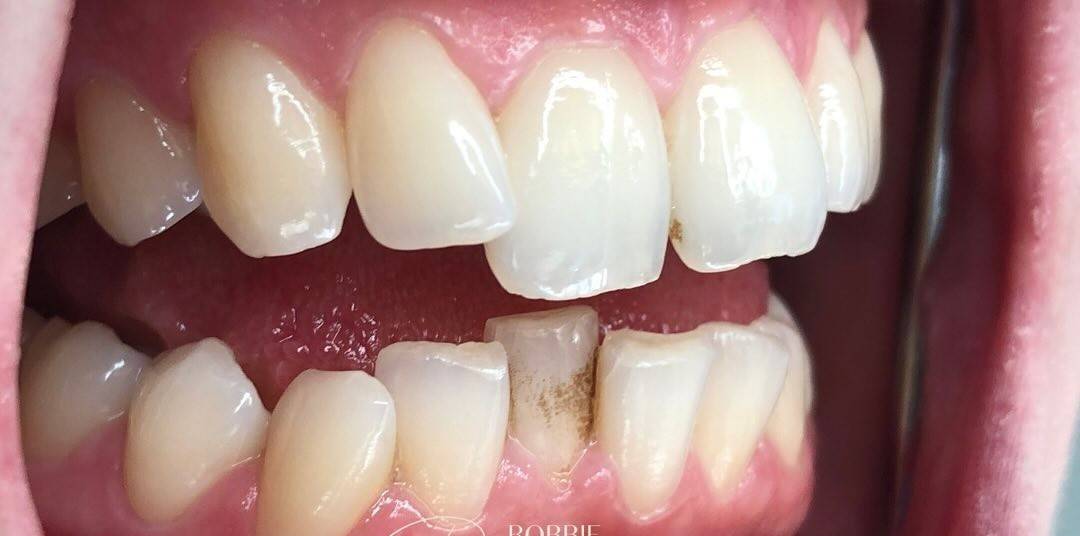 close up of patient crowded teeth with overlapping teeth before invisalign treatment with Robbie Thompson