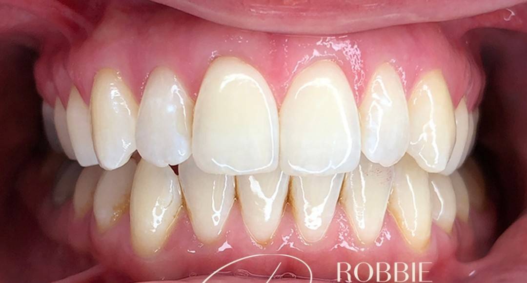 close up of patients white and aligned smile following invisalign and whitening treatment with Robbie Thompson