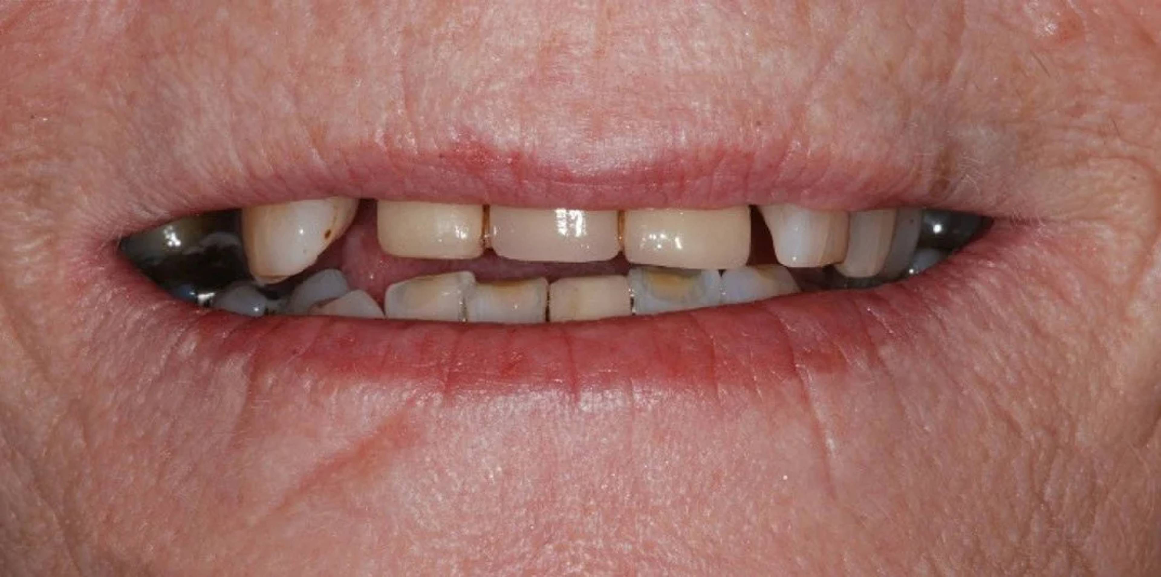 Bath spa dentistry same day teeth implants before